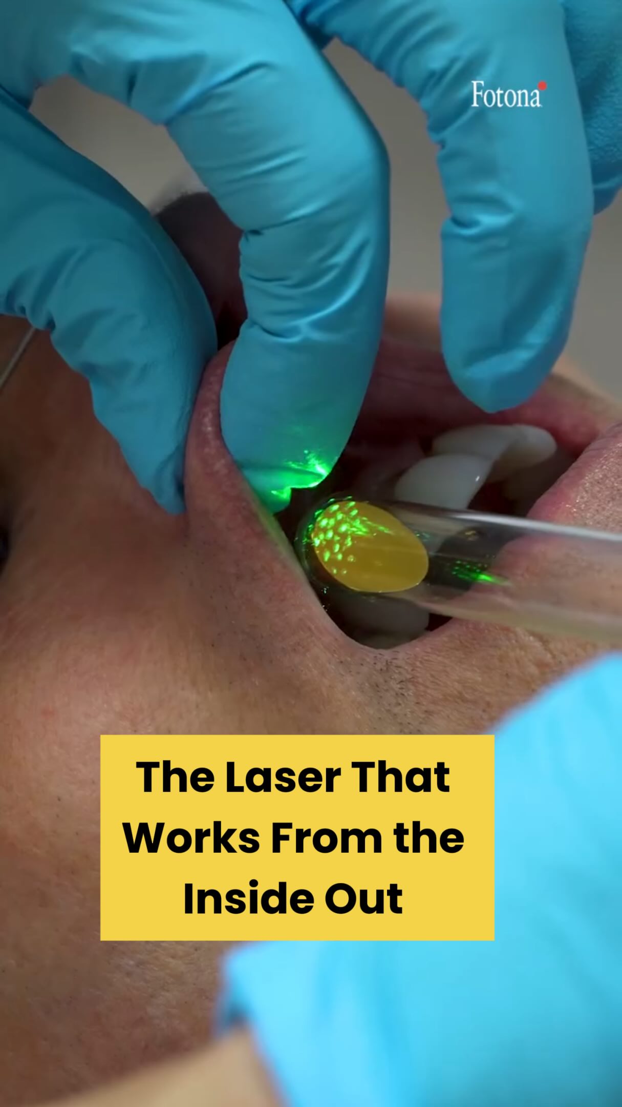✨ One treatment. Four dimensions of rejuvenation. Meet Fotona4D®️—Fotona’s patented, four-step laser protocol. 💫
Here’s how it works:
1️⃣ SmoothLiftin™️
Gently heats oral tissue from inside the mouth to stimulate collagen and create a natural tightening and plumping effect.
2️⃣ FRAC3®️
Targets deeper imperfections to improve pigmentation, texture, redness, and, in appropriate patients, broken capillaries.
3️⃣ PIANO®️
Delivers controlled heat to deeper tissues for collagen remodeling, improved firmness, and tightening.
4️⃣ SupErficial™️
Refreshes the skin’s surface with a light laser peel to smooth crepiness, brighten dullness, and reveal a healthy glow. ✨
By treating multiple facial layers—from inside the mouth to deeper supporting tissues and the skin’s surface—Fotona4D®️ provides comprehensive, natural-looking rejuvenation. 🤍
Depending on your needs, this customizable treatment can improve:
✨ Skin laxity
✨ Hyperpigmentation
✨ Dullness and uneven tone
✨ Crepiness and texture
✨ Redness and broken capillaries
✨ Firmness and luminosity
At V Boutique, we may pair Fotona4D®️ with regenerative injectables such as Radiesse®️ and Sculptra®️. When properly sequenced, these treatments can stimulate collagen and elastin production while enhancing and extending results. 💉✨
Ready to discover whether Fotona4D®️ is right for you? Book your personalized consultation at V Boutique: (561) 357-2020. ✨
#Fotona4D #FotonaLaser #NaturalRejuvenation #CollagenStimulation #nonsurgicalfacelift