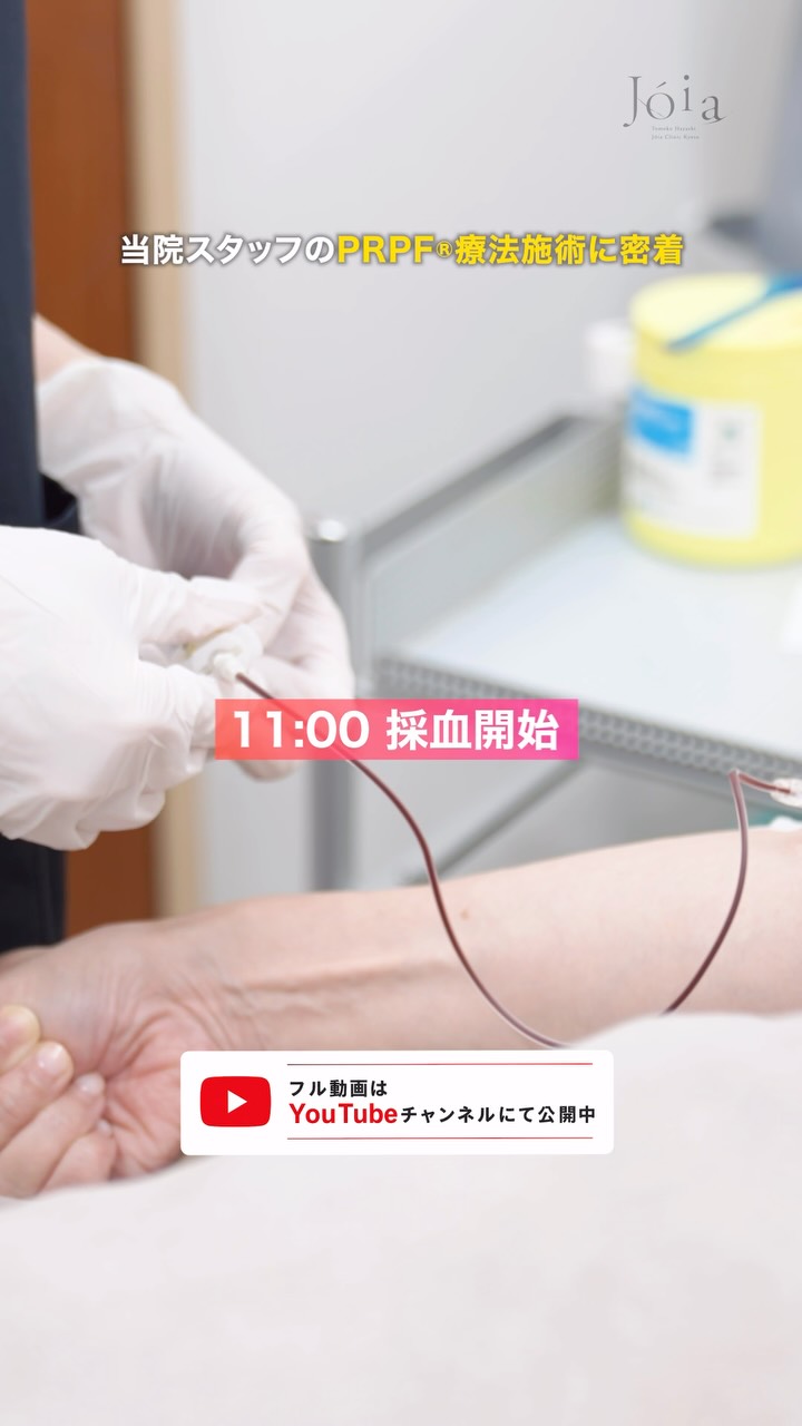 .
.
【 PART ② 】
毎日PRPF®療法を受けられる患者様を見ている当院スタッフが、今回実際にPRPF®療法を受けました。
🗣️「患者様がPRPF®で綺麗になっていかれるのを拝見することも多く、私も院長にしていただきたいと思いました」
今回気になっていたのは、目の下のたるみをはじめとした顔全体の印象。
動画では、林院長による施術前の診察から、実際の施術、施術中の痛み、施術直後の状態まで詳しくご紹介しています。
・どの部分にPRPF®を注入したのか
・施術中の痛みはどの程度だったのか
・施術直後はどのような状態なのか
・翌日の腫れやダウンタイムについて
・施術後に気をつけること
など、実際に施術を受けたスタッフの感想と
ともにお届けします🎥♪
「PRPF®療法が気になっているけれど、痛みやダウンタイムが心配💦」
「実際の施術の様子を見てから検討したい」
という方は、ぜひ最後までご覧ください。
◼︎ ジョイアクリニック京都 公式HP
https://joia-clinic.com/
◼︎ ジョイアクリニック京都 林院長 Instagram
https://www.instagram.com/dr.joia_kyoto/
◼︎ LINEでのお悩みご相談・ご予約はこちら
https://page.line.me/628uvswq?openQrModal=true
Joia Clinic Kyoto
ジョイアクリニック京都
京都府京都市中京区烏丸通姉小路下ル場之町599 CUBE OIKE 3F
電話番号 075-229-6388
#PRPF #PRPF療法 #再生医療 #美容医療 #目の下のクマ 目の下のたるみ ほうれい線 マリオネットライン 美容クリニック ジョイアクリニック京都