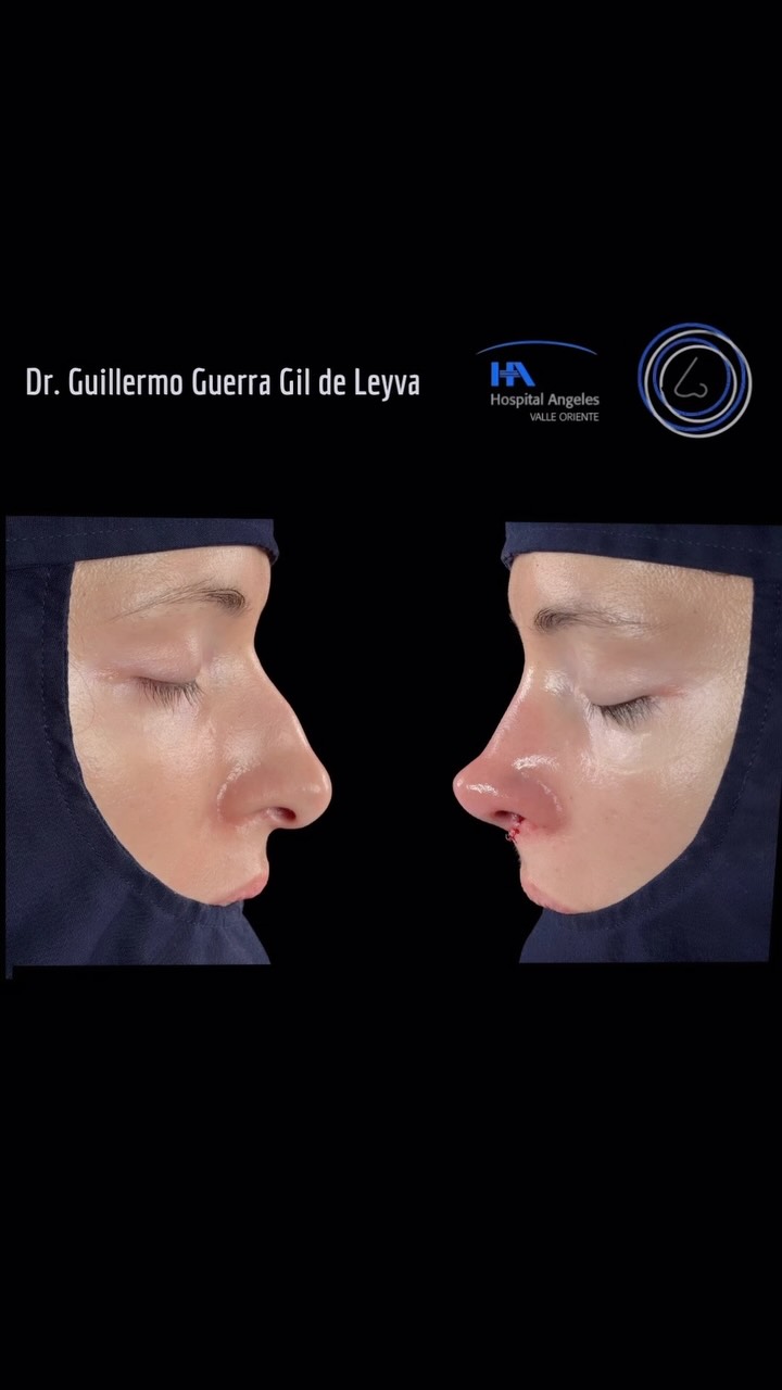 🔹Cada procedimiento es personalizado, planificado con precisión y ejecutado con técnica y experiencia. La Rinoplastia es arte y ciencia combinados.
🔹Resultado inmediato Rinoplastia Estética y Funcional.
🔹 Gracias a mi excelente paciente por su confianza y permitir compartir su resultado.
🔹”Made by hand. Crafted with passion”
🧑⚕️ Dr. Guillermo Guerra Gil de Leyva
🏥 Hospital Ángeles Valle Oriente
📱 81-1252-0132
🎓Universidad de Monterrey
👃 Rinoplastia Estética y Funcional
🚫 No taponamiento
Cédula Profesional: 3070499
Cédula Especialista: 4503273
No. Certificación CONACEM: GUG-1748/04
Aviso de Publicidad COFEPRIS: 2419032002A00111
❕Paciente autoriza difusión de imágenes con fines académicos e informativos.
❕Los resultados finales se pudieran observar hasta un año de la cirugía y dependerá tanto del compromiso del cirujano como del paciente, así como del tipo de cirugía, tipo de piel, cuidados post-operatorios, etc.
#CirugíaFacial #RinoplastiaEspecializada
#rinoplastia #rhinoplasty #septoplastia septoplasty rinoseptumplastia rhinoseptoplasty nosejob nose nosesurgery tabiquenasal otorrinolaringologia entsurgery cirugianasal cirugiatabique cirugiaesteticanasal
belleza confianza autoestima
cosmeticsurgery
otorrinolaringologiamonterrey otorrinomonterrey beforeandafter antesydespues
estructuredrhinoplasty
rinoplastiaestructurada
rinoplastiaultrasonica
ultrasonicrhinoplasty