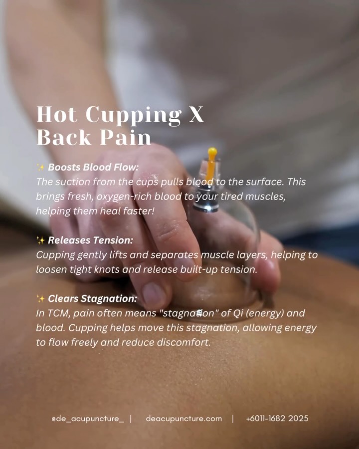 OMG, what are those big red circles on your back?? 🔴😱
Don’t panic, it’s just the ‘marks of honour’ from Hot Cupping! 🔥
If your back feels stiff, heavy, and sore like carrying a sack of rice all day, you probably have a lot of Dampness & Stagnation stuck inside. 😩
This is why regular massages don’t fully work! You need something to pull the “bad stuff” (like Wind, Cold, and Dampness) out from deep inside the muscle. That’s where Hot Cupping shines! ✨
The magic of Cupping for Back Pain:
Sucks Out Stagnation:
The suction pulls stagnant blood (Qi Stagnation) and toxins to the surface. Instant ringan (light) feeling! 🌬️
Warms the Muscles:
The heat helps relax tight knots and relieves deep cold/dampness that causes chronic pain. ♨️
Improves Circulation:
Brings fresh, oxygenated blood to the area for faster healing and muscle recovery. 🩸
Have you ever tried Cupping and been shocked by how good your back felt after? Tell us in the comments! 👇
Cupping is super effective, but a qualified TCM practitioner needs to decide if it’s right for your pain type! (Not all back pain is the same!)
Don’t DIY with those suction cups! Consult our qualified practitioners at 医心医意中医坊 De Acupuncture x Herbs Centre (USJ area) first.
We’ll combine Cupping with the right plan to permanently fix the root cause of your back pain.
Ready to feel light and pain-free? Click the link in our bio to book your session today! 💖
#CuppingTherapy #HotCupping #BackPainRelief #TCM #subangjaya