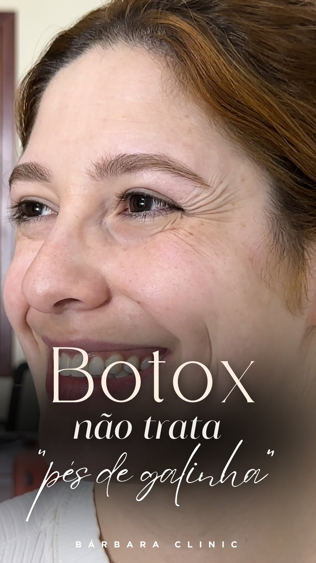 Quando somos jovens, sorrir, apertar os olhos, rir e fazer expressões não significa necessariamente criar uma ruga permanente. A pele tem uma estrutura mais íntegra, com mais colágeno, elastina e capacidade de acompanhar esses movimentos.
Com o passar dos anos, essa estrutura muda. A pele perde sustentação, elasticidade e capacidade de retornar completamente à posição inicial. Então aquela mesma contração que antes não deixava uma marca permanente começa a deixar.
É aí que entra a toxina botulina, o popular Botox.
Ela age no músculo, reduzindo temporariamente a sua contração. Com menos movimento, a pele dobra menos e, consequentemente, aquelas linhas ficam menos aparentes.
Mas o efeito passa. E se, nesse intervalo, você não tratar também da pele, a mesma pele que já estava fragilizada vai ficando cada vez mais flácida com o passar dos anos, pelo processo de envelhecimento.
Por isso, quando uma paciente chega até mim incomodada com os pés de galinha, eu não penso apenas em “aplicar botox”.
Eu penso no que está acontecendo com aquela pele e no que podemos fazer para melhorar a sua qualidade, enquanto controlamos o movimento que está contribuindo para a formação das rugas.
Porque rejuvenescer não é simplesmente impedir que o rosto se mova. É fazer com que a pele tenha cada vez mais condições de acompanhar esse movimento sem carregar todas as marcas dele.
É esse olhar que orienta a minha estratégia na MAB®. O procedimento pode fazer parte do tratamento, mas ele sozinho não trata o que realmente incomoda.
Se você quer tratar os “pés de galinha” e não apenas disfarçá-los temporariamente, esse cuidado precisa acontecer na pele.
Na Consulta MAB®, eu defino a estratégia de tratamento personalizada para o seu caso.
Agende sua consulta pelo link da bio.
#botox #pesdegalinha #esteticauberaba #botoxuberaba #uberabamg