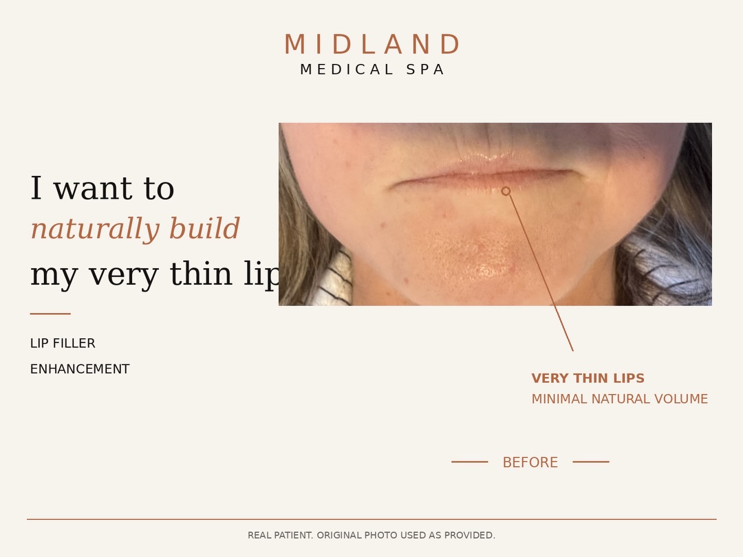 From very thin lips to softly balanced, natural volume 👄
This treatment was never about creating a dramatic change. The goal was to build the lips gradually, preserve their natural shape and improve proportion without making them look overfilled.
What we focused on:
• Gentle volume rather than bulk
• Maintaining the natural Cupid’s bow
• Soft definition through the vermilion border
• Keeping the lips in proportion with the rest of the face
• Building slowly so the tissue can adapt naturally
With very thin lips, patience matters. Trying to create too much volume in one session can compromise the result, so a progressive approach is often the best way to achieve something that still looks like you.
#LipFiller #NaturalLipFiller #LipEnhancement #DermalFillers #NaturalAesthetics