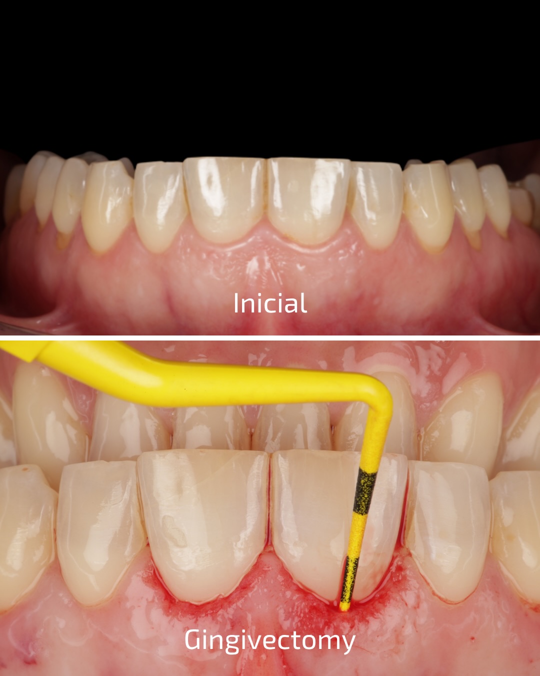 Neste caso feito durante a nossa formação ReCreate Dental Course apresentamos o processo completo. Inicialmente, o @dr_carlosvictorborges (OMD 12975) realizou uma gengivectomia para harmonizar as proporções dentárias. Em seguida, @diogosalvadodentistry (OMD 14147) clareou o sorriso do paciente. Após a aprovação do mock-up, as facetas cerâmicas foram confeccionadas e cimentadas em um procedimento ao vivo junto com a @inesbcbarbosa .
-
In this case, performed during our ReCreate Dental Course we walk you through the multi-step process. First, Dr. @dr_carlosvictorborges (OMD 12975) performed a gingivectomy to correct tooth proportions. Next, @diogosalvadodentistry (OMD 14147) brightened the patient’s smile with professional bleaching. After approving the mock-up, porcelain veneers were meticulously crafted and cemented during a live procedure together with @inesbcbarbosa
#dentistry #facetascerâmicas #dentalcourse #veeners dentistaemlisbo