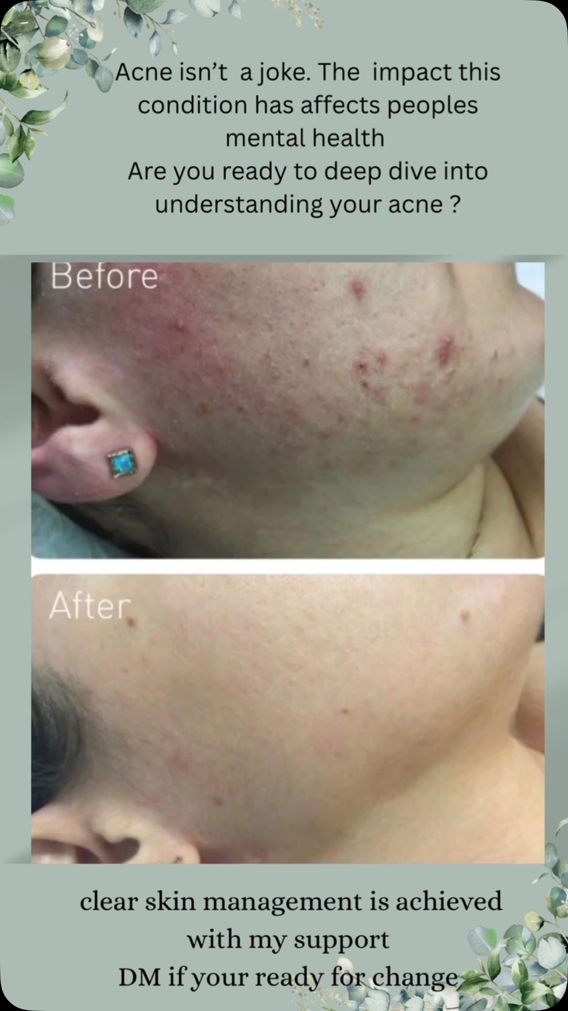 Acne thrives from incorrect treatment, wrong ingredients, allowing your neurogenic reaction to have a party from oil overload plus it thinks it’s Christmas when you don’t exfoliate!!
Using Noon aesthetics products I create a 360 approach to controlling all grades of acne.
These products contain an extraordinary technology allowing me to prescribe high percentages of acids and other compounds with no flaking, dryness, irritation as well as keeping your skins Ph level in the correct place !
Now is a great time to start your Acne journey .
DM to discuss your concerns .
👉🏻TRIAL SIZE PRODUCTS AVAILABLE
🙌🏻ZOOM CONSULTATIONS AVAILABLE- products delivered to your door
Anna ❤️
@noon_aesthetics.uk
#acne #clearskin #bedfordshire #blackheads #whiteheads