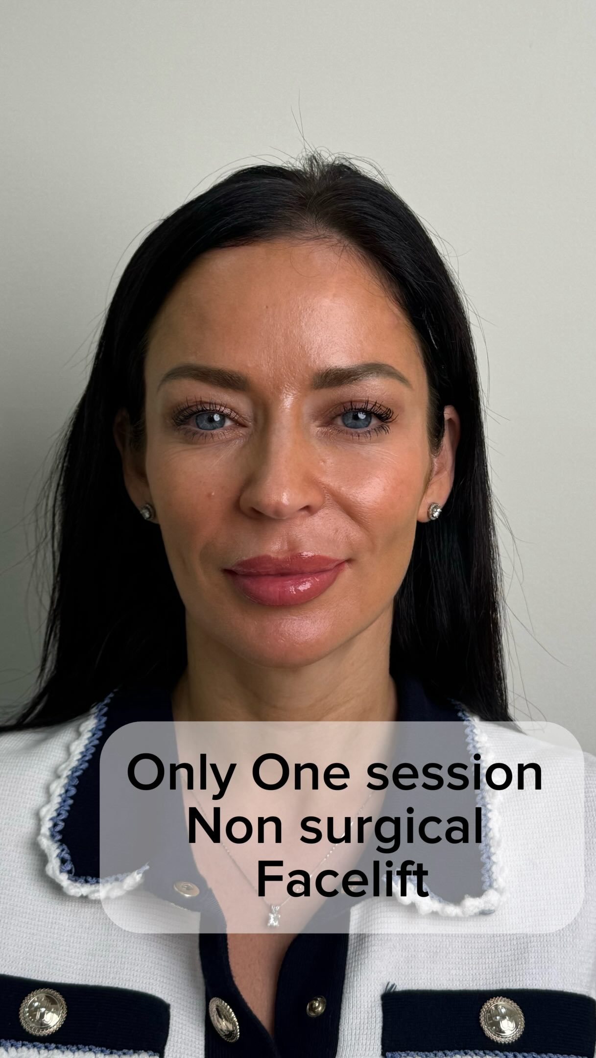 💡One session. One month later.
🟢With Endolift, what you see immediately after treatment is not the result I judge.
🔺The immediate tightening can look impressive, but part of it is temporary. Over the following weeks, that settles and the tissue remodeling gradually starts to become visible.
✅This is her result at one month — with a noticeable improvement in the lower face, jawline and neck, while still looking like herself.
🔺And importantly, one month is still early. The remodeling process continues over the following months, with the result usually becoming more evident around 3 months.
✅If your concern is lower-face or neck laxity and you’re wondering whether Endolift is suitable for you, book a consultation for an individual assessment.
.
.
.
#endoliftdubai #endolift