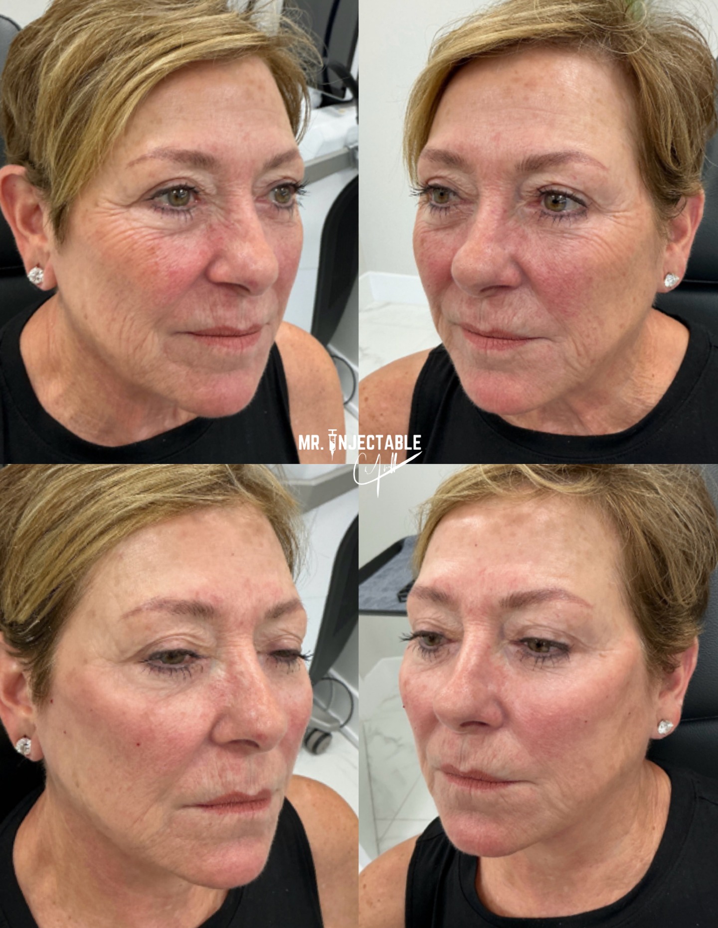 ✨ Define. Restore. Stimulate. ✨
Radiesse® is more than just a filler — it’s a biostimulator that provides immediate structure while helping stimulate your body’s natural collagen and elastin production over time.
Perfect for enhancing areas like the jawline, chin, lower face, and hands while improving firmness and overall skin quality. 💉
Natural-looking definition today, with benefits that continue developing over time.
Call or text today to book your appointment!
☎️ 239-448-3383
📩 chris.jewell@jewellmedicalspa.com
🌐 www.jewellmedicalspa.com | www.mrinjectable.com
📍 1044 Castello Drive, Ste 213 Naples Florida 34103
💳 We Accept Care Credit!
*
*
*
#Radiesse #Biostimulator #CollagenStimulator #FacialBalancing #JawlineFiller #ChinFiller #AestheticMedicine #NaplesMedSpa #JewellMedicalSpa
