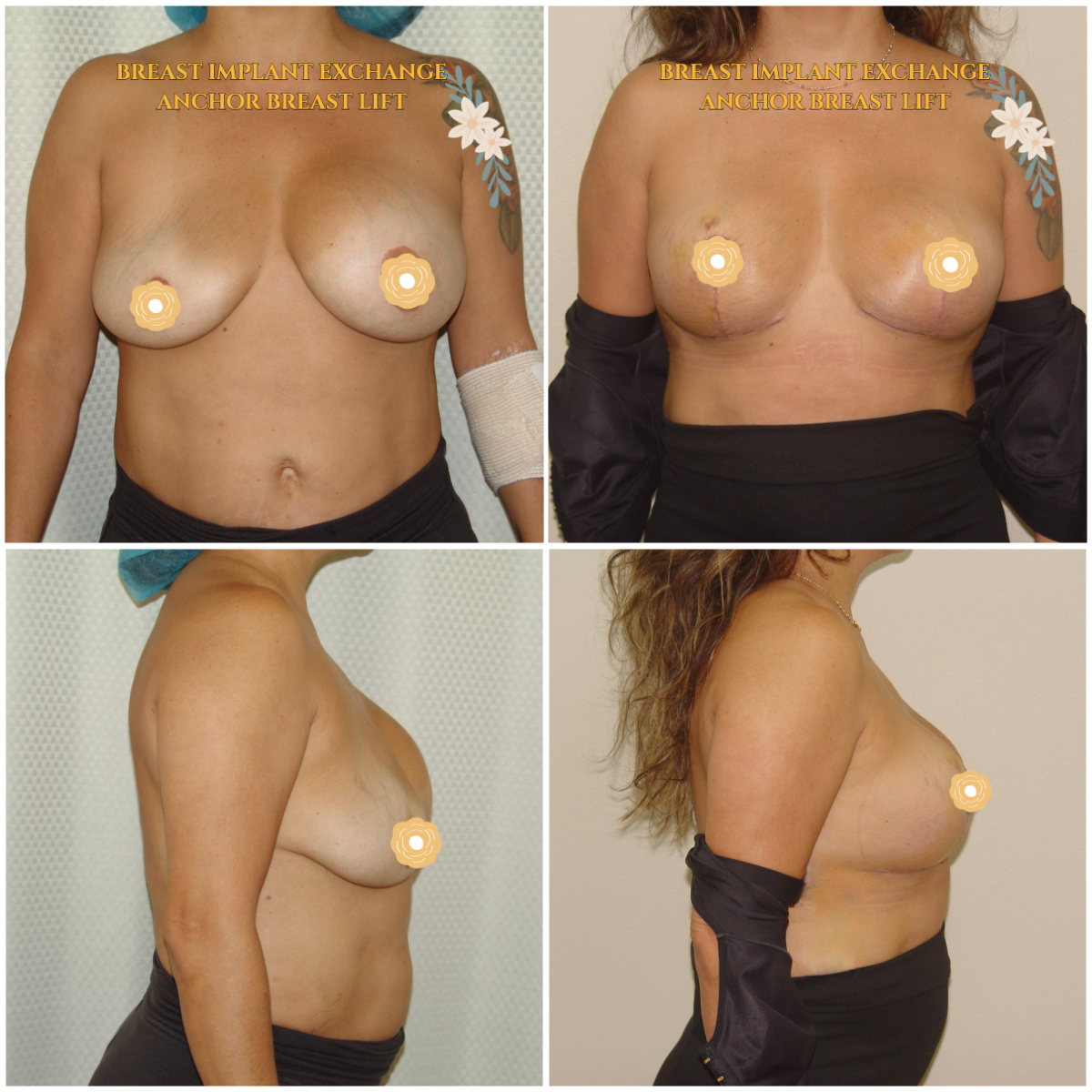 Call now for our Mid-Summer Specials! Saline Breast Aug -->$3995 Silicone Breast Aug --> $6495 Tummy Tuck starts at --> $7995. Call (714) 500-0050 #drluudoan #breastaug #salineimplants #siliconegelimplants #tummytuck #abdominoplasty