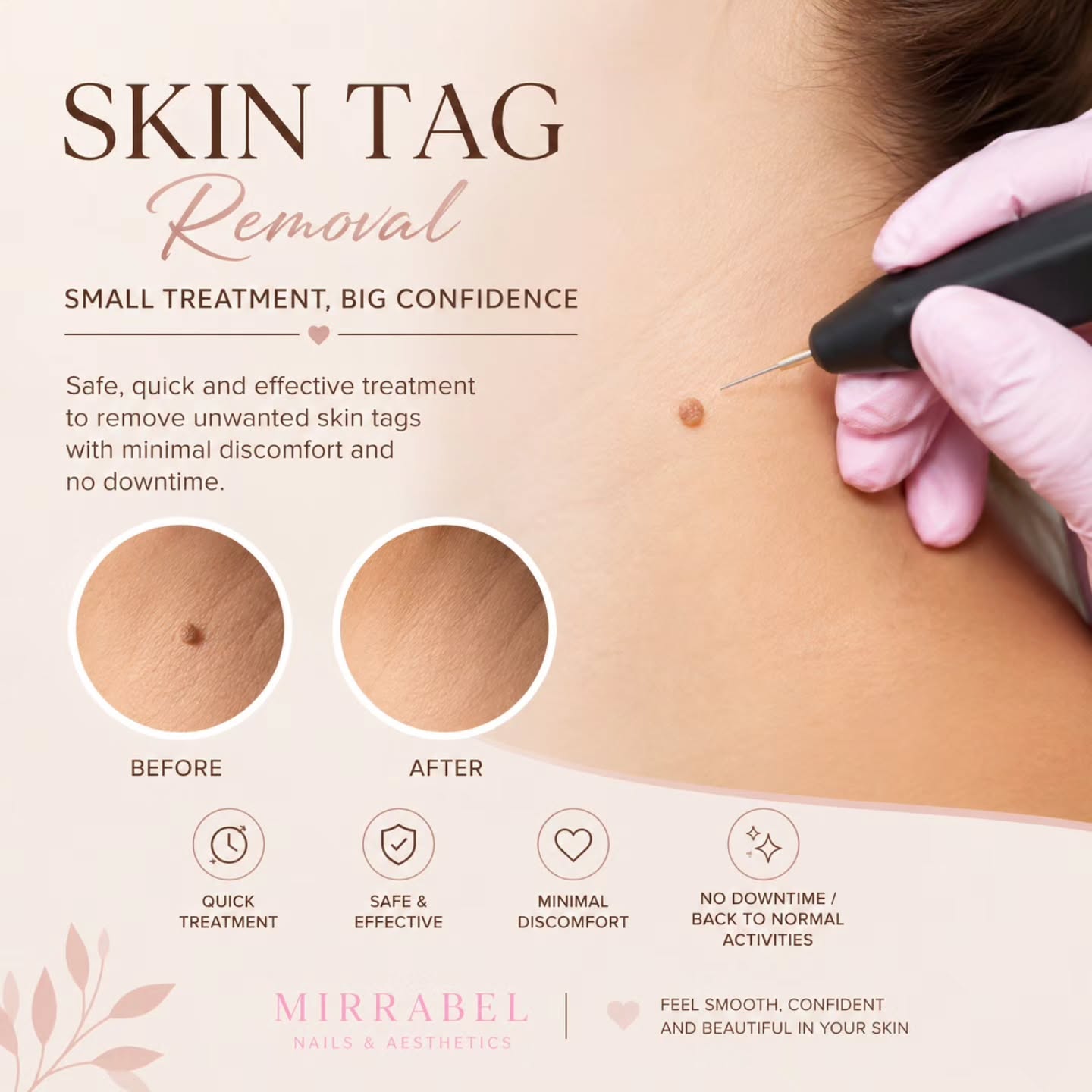 ✨ Skin Tag Removal ✨
Say goodbye to unwanted skin tags and hello to smoother-looking skin! 🤍
A quick and precise treatment designed to help you feel more confident in your skin. ✨
📩 DM us to book your consultation.
#SkinTagRemoval #SkinTags #AestheticTreatment #SkinCare #SmoothSkin