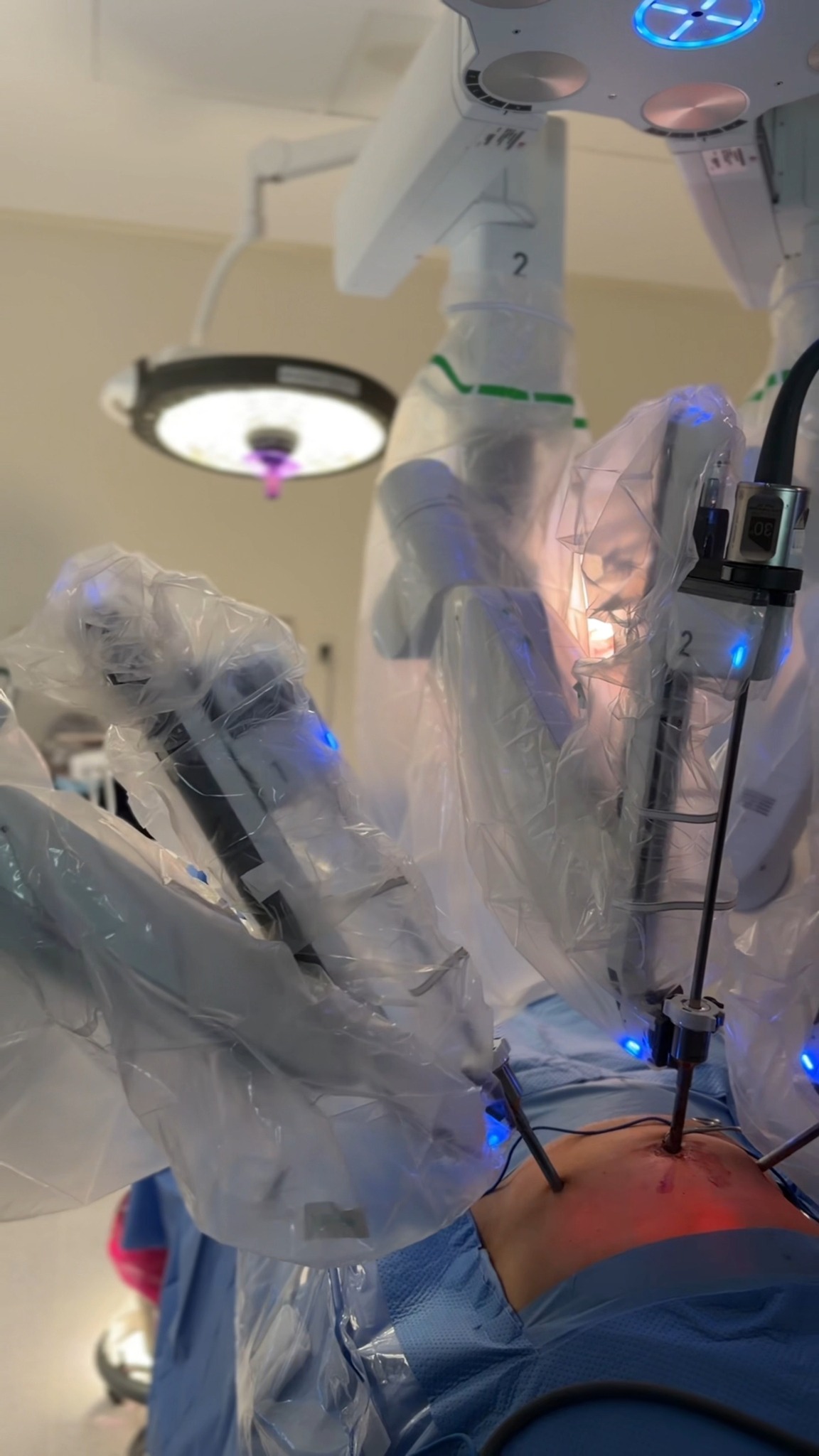 Una experiencia de cirugía robótica de hernia
Cada paciente vive su proceso de forma distinta, y conocer su experiencia también ayuda a entender lo que implica una cirugía de hernia.
En este testimonio, el paciente comparte cómo fue su proceso alrededor de una cirugía robótica, desde la atención recibida hasta su recuperación.
La tecnología puede ser una herramienta importante en casos seleccionados, pero siempre debe ir acompañada de una valoración adecuada y una estrategia quirúrgica personalizada.
📍 Pachuca / CDMX
#hernia #cirugiarobotica #cirugiadehernia #cirugiageneral #pachuca