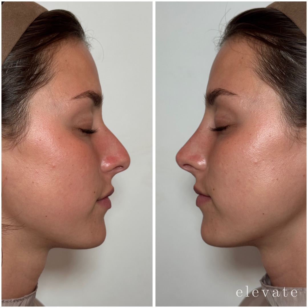 Another beautiful liquid rhinoplasty by our nose expert @injector_tristan. Profile refinement with no surgery necessary!
Treatment provider:
Tristan Baron, APRN
@injector_tristan