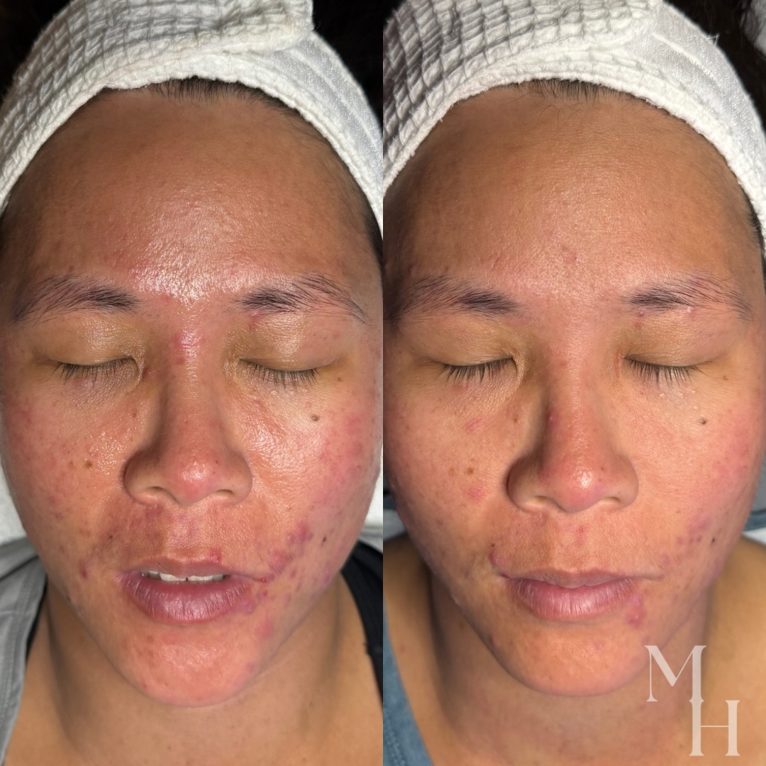 A two week difference with my Acne Boot Camp🙌🏻
- Less redness
- Less oil
- Less inflammation
- Fewer active breakouts
- Refined texture
- More even skin tone
- Calmer, healthier skin
I am so excited to follow her progress! Ready to start your own journey to clear skin?
👩🏻💻 Schedule an Acne Boot Camp Consultation!
✨ Now Accepting New Clients ✨
📍 Location:
664 Scranton Road, Suite 101
Brunswick, GA 31520
Inside Skinology Clinical Skincare
💬 Let’s Chat About Your Esthetic Goals!
📲 Call/Text: 912-223-9954
💌 DM or Facebook Messenger
🗓️ Schedule a Consultation Anytime
💻 Book Online 24/7 (link in bio)