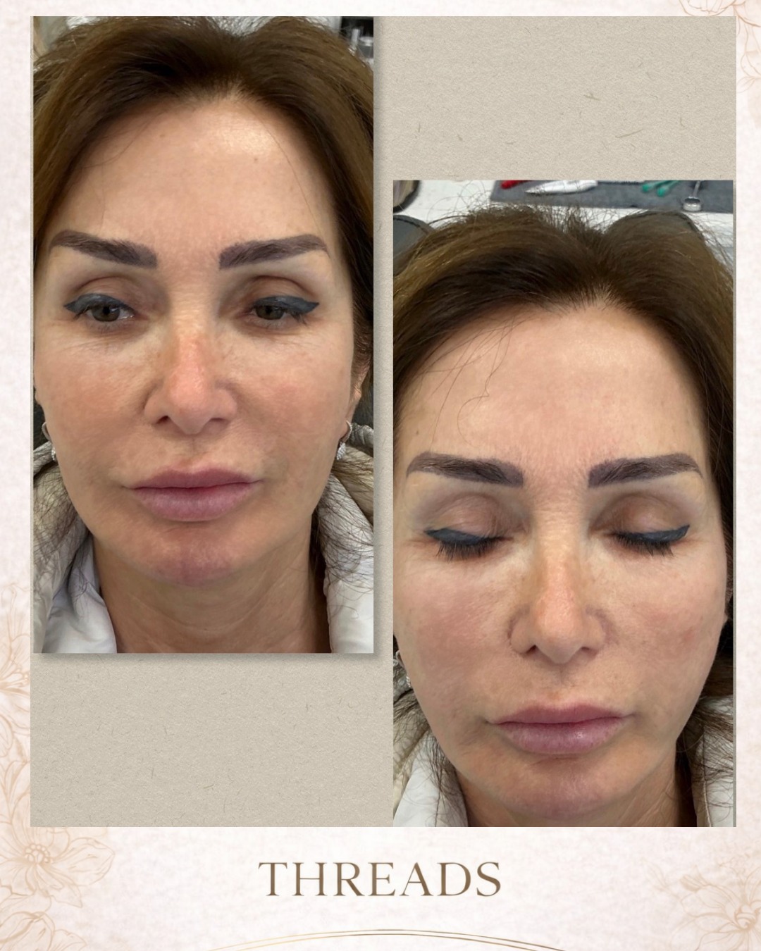 ✨ Lift. Tighten. Rejuvenate. ✨
Threads are one of the most effective non-surgical treatments to lift sagging skin while stimulating your body's natural collagen production. The result? A more youthful, refreshed appearance that continues to improve over time.
Call or text today to book your appointment!
☎️ 239-448-3383
📩 chris.jewell@jewellmedicalspa.com
🌐 www.jewellmedicalspa.com | www.mrinjectable.com
📍 1044 Castello Drive, Ste 213 Naples Florida 34103
💳 We Accept Care Credit!
*
*
*
#smooth #threads #skin #tightening #acne #scaring #injections #naples #naplesfl #naplesinjector #aesthetics #injectables #cosmeticinjectables #beforeandafter