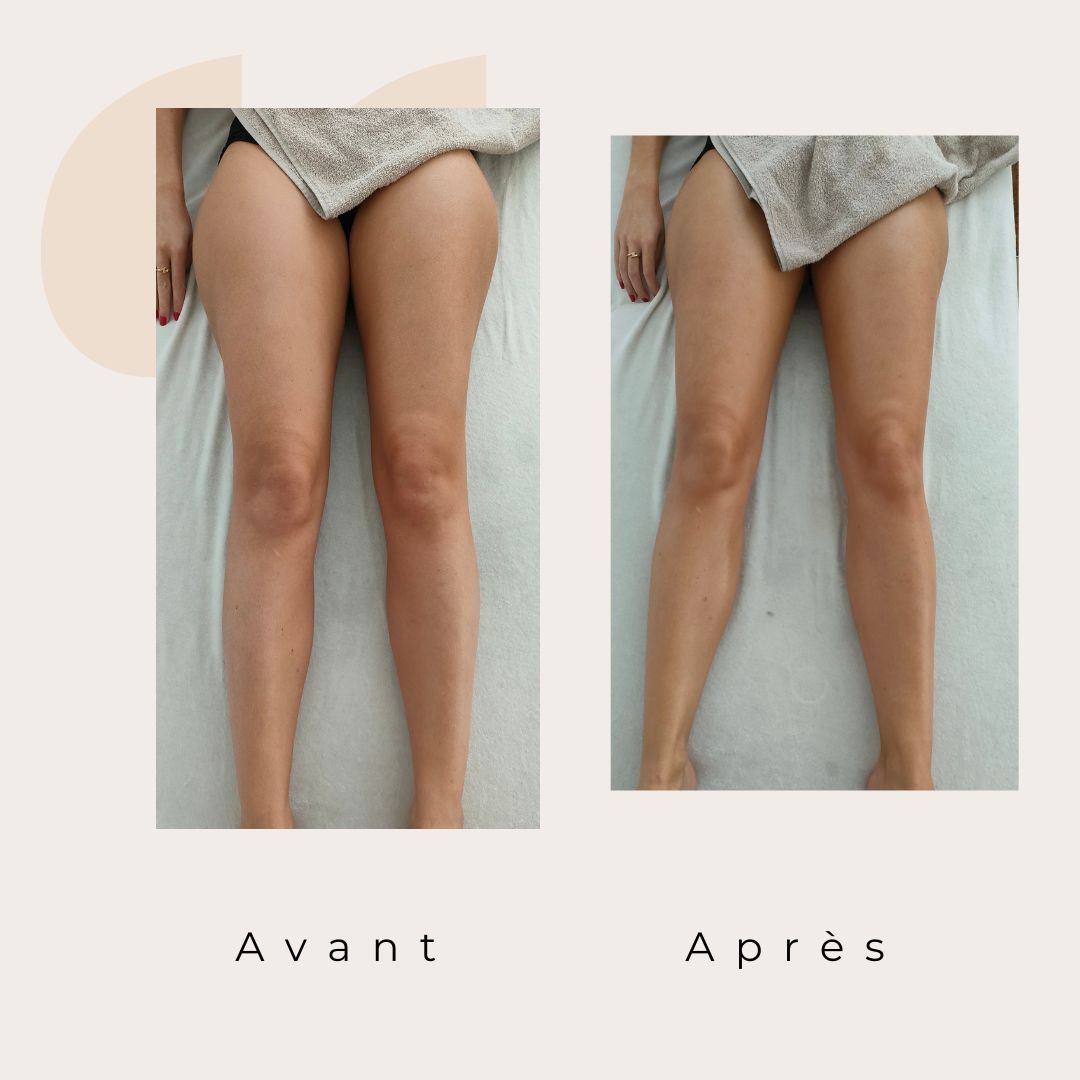 ✨ Avant / Après – Drainage lymphatique Renata França ✨
Dès la première séance, le corps réagit.
Des jambes visiblement plus légères, un galbe redessiné et une sensation immédiate de bien-être 🌿
Le drainage lymphatique Renata França agit en profondeur pour :
✨ stimuler la circulation lymphatique
✨ réduire la rétention d’eau
✨ affiner et détoxifier les jambes
✨ apporter une sensation de légèreté durable
Résultat visible, ressenti immédiat 🤍
Chaque corps est unique, les résultats peuvent varier, mais la légèreté, elle, est toujours au rendez-vous ✨
#drainagelymphatique #renatafranca #avantapres #jambeslegeres #retentiondeau #bienetre #soincorps #detox #momentpoursoi