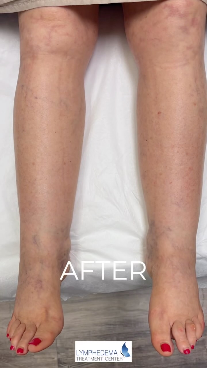 Less swelling. More comfort. A difference you can see. 💙
This before-and-after shows the progress that can be possible with consistent, specialized lymphedema treatment. At Lymphedema Treatment Center in Jupiter, our experienced therapists create individualized treatment plans to help reduce swelling, improve mobility and support a better quality of life.
Every patient’s journey is different, but no one has to navigate it alone.
📍 Jupiter, Florida
📲 561-768-9984
Contact us to learn more or schedule an evaluation.
#LymphedemaTreatment #LymphedemaRelief #JupiterFL #SwellingManagement #LymphaticHealth