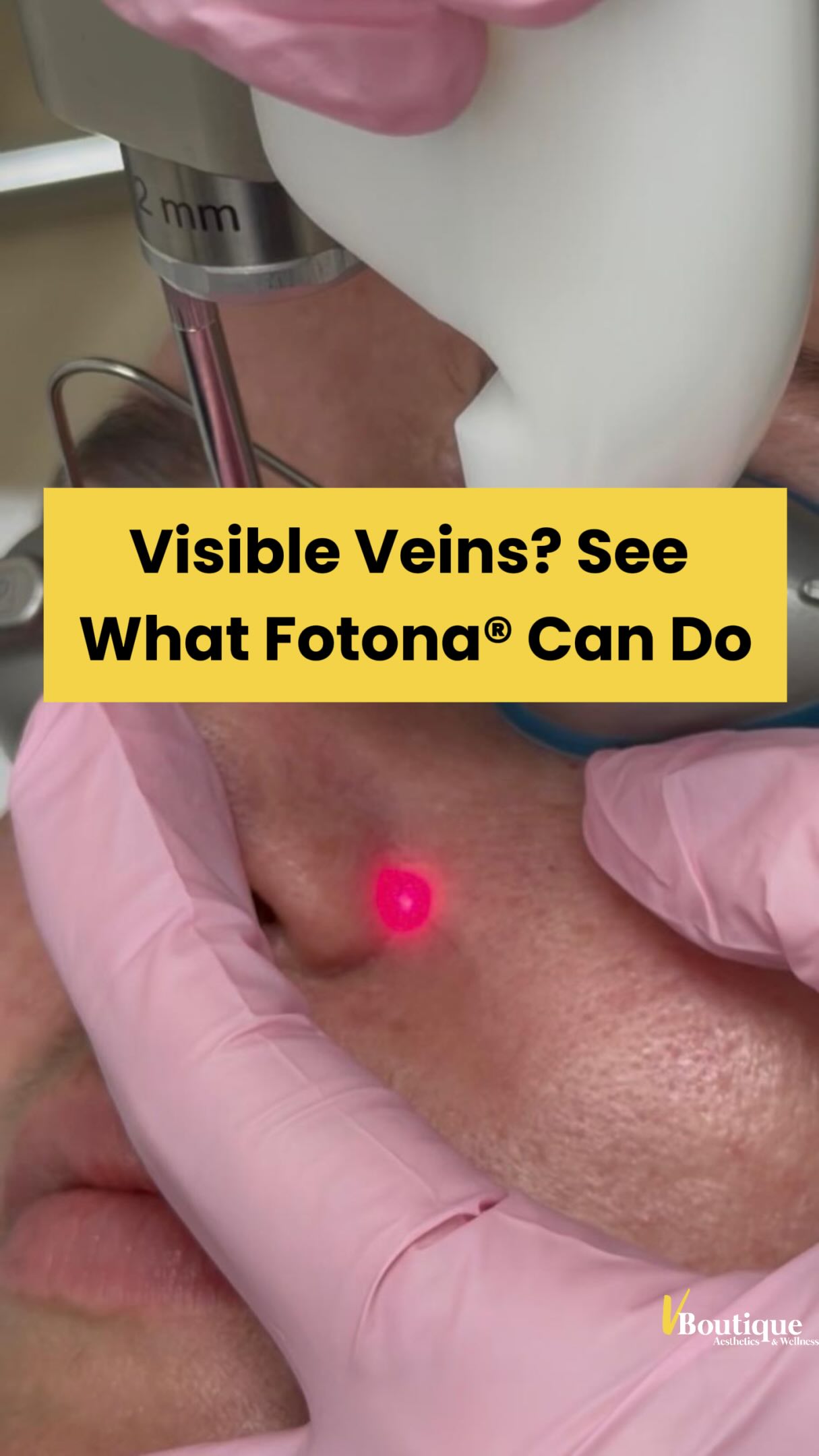 Watch this vessel disappear in real time. ✨🩸
The Fotona long-pulsed 1064 nm Nd:YAG laser treats visible vascular lesions by penetrating the skin and selectively heating hemoglobin within the target vessel. This causes the vessel walls to coagulate and close while protecting surrounding tissue; the body then gradually clears the treated vessel.🎯
With individualized settings for spot size, pulse duration, and energy, it can treat:
🔴 Facial capillaries and telangiectasias
🔵 Blue or purple superficial veins
🕷️ Spider veins and small reticular leg veins
✨ Visible vessels on the face, nose, neck, chest, and extremities
🍒 Cherry angiomas
🩸 Selected benign hemangiomas, venous lakes, and other vascular lesions
Some vessels disappear immediately; others darken or fade gradually. One treatment may be enough for an isolated lesion, while deeper or more extensive vessels may require a series.⏳
Safe, effective treatment depends on accurate diagnosis and precise adjustment of wavelength, fluence, pulse duration, spot size, cooling, and clinical endpoint. 🎯
Call us at (561)357-2020 to make an appointment!
#FotonaLaser #Rosacea #VascularLaser #SpiderVeinTreatment #CherryAngioma