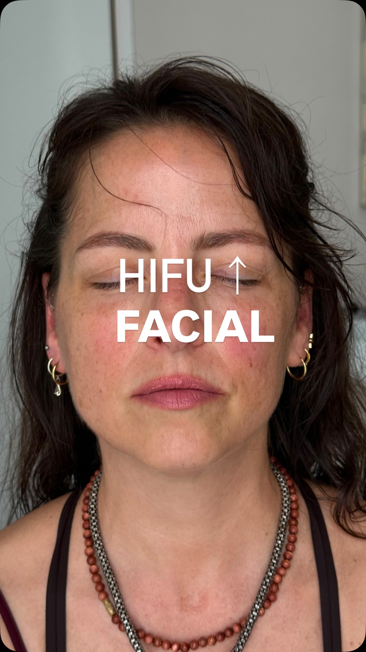 Hifu 7 days post treatment update 🤩!!
#fyp #hifu #beforeafter #aesthetic #skintightening
