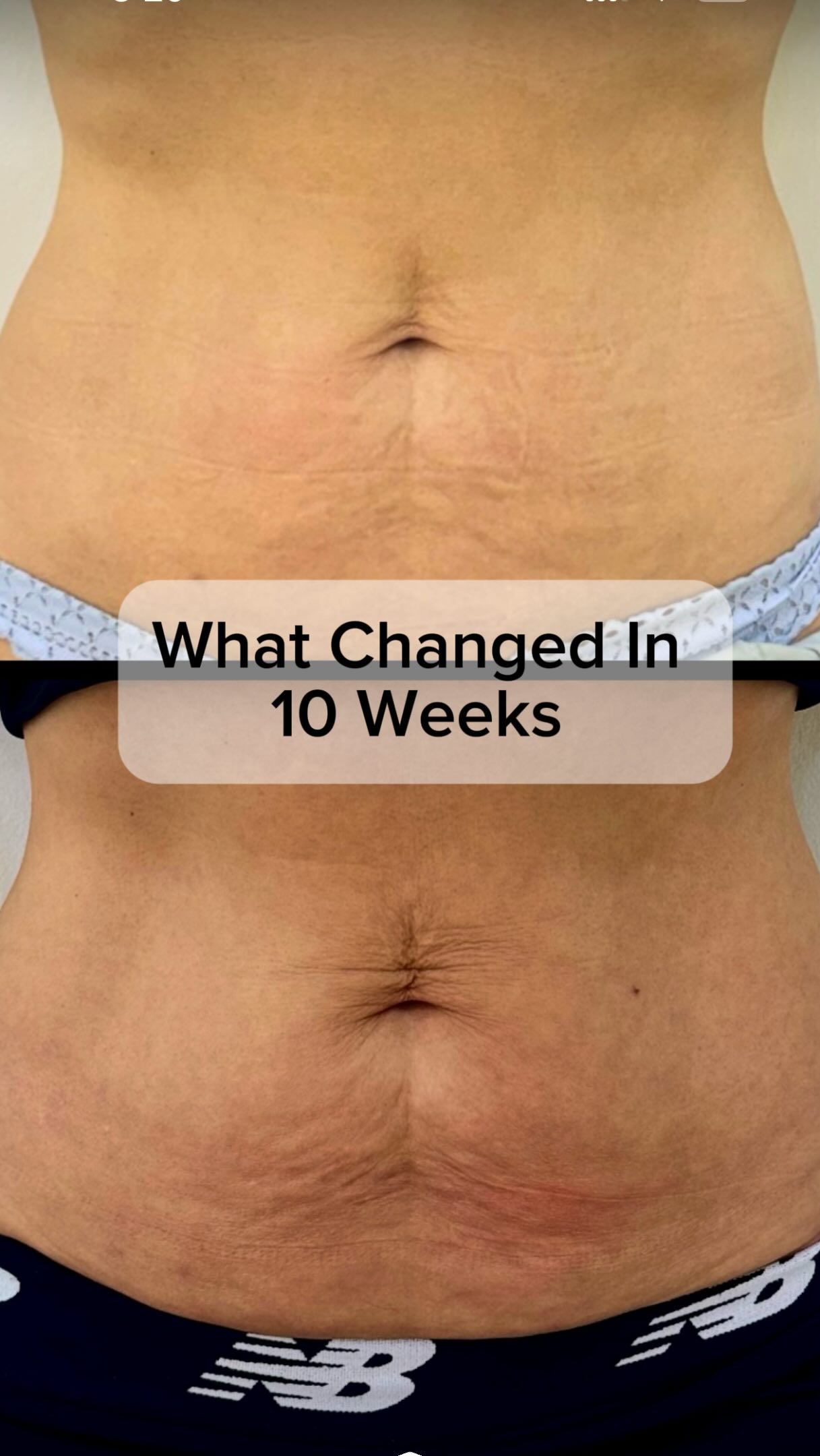 🟢Around 10 weeks after Endolift.
✅What I like about this result is not only the change in the abdominal contour, but also what happened to the skin itself.
💡Look closely at the lower abdomen — the skin looks firmer, the laxity has improved, and the texture is noticeably smoother.
🟢This is what I look for when treating the abdomen with Endolift: improvement in the overall contour together with progressive tightening and remodeling of the skin.
🔺And at around 10 weeks, this process is still continuing.
💡The amount of improvement will always depend on the starting point — the amount and distribution of fat, degree of skin laxity, skin quality, and how the tissue responds to treatment.
.
.
.
#endoliftdubai #endolift