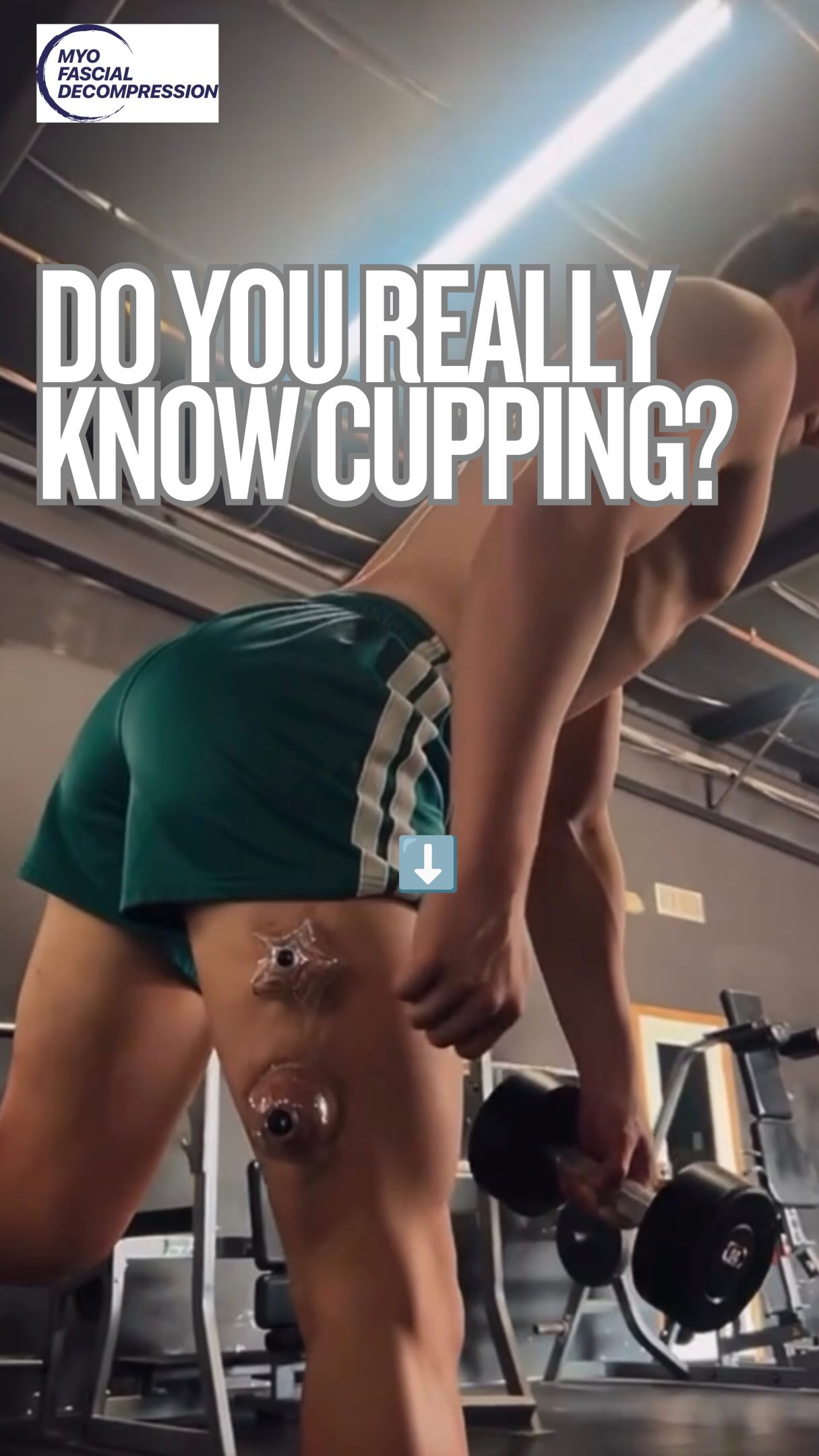 Sound on 🔊 Most cupping courses were written before we understood the real mechanics of fascia — so you get taught the same thing everyone’s grandmother knew: slap on a bunch of cups, crank the suction, and call the bruising “toxins leaving the body.” No pressure control. No imaging to confirm what’s actually happening under the skin. No connection to load or movement. Just static suction and a story that doesn’t hold up to modern manual therapy.
Myofascial Decompression courses exists because the tissue deserves better than a guess. MRI data, pressure gauges, curved cups designed to follow fascial mechanics instead of just pinching skin, and active movement built into every application — this is what it looks like when cupping catches up to the science. Your outcomes don’t improve because you added more cups. They improve because you finally know what you’re doing with the ones you have. Time to level up 🤓