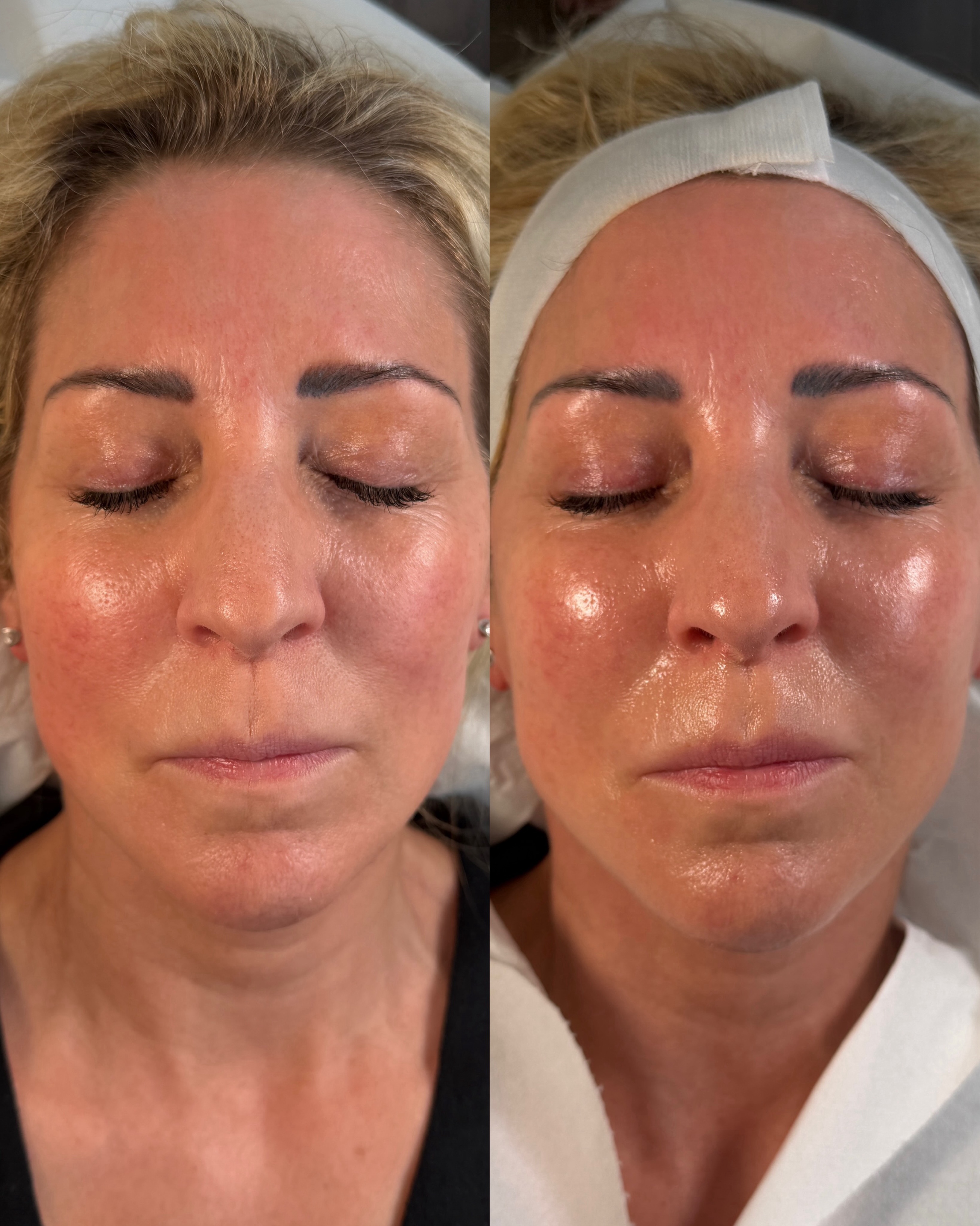 IT’S PEEL SEASON 🍂 getting glowy skin even glowier 🍂
As the weather cools down, autumn is the perfect time to give your skin a reset with professional chemical peels ✨
☁️ Less sun exposure - UV levels are lower, making it easier to protect freshly treated skin.
✨ Tackle summer damage - Peels can help improve the appearance of pigmentation, uneven tone and sun damage.
🧖🏼♀️ Boost skin renewal - Encourage fresh, healthy-looking skin by removing built-up dead skin cells.
💧 Improve texture & glow - Skin can feel smoother, brighter and more refined.
🍁 Perfect preparation for winter - Get your skin hydrated, balanced and glowing before the colder, drier months arrive.
Whether you’re looking to target pigmentation, acne, congestion, fine lines or dullness, there’s a peel to suit your skin and goals.
📩 Ready to start your autumn skin reset? DM us to book your consultation.