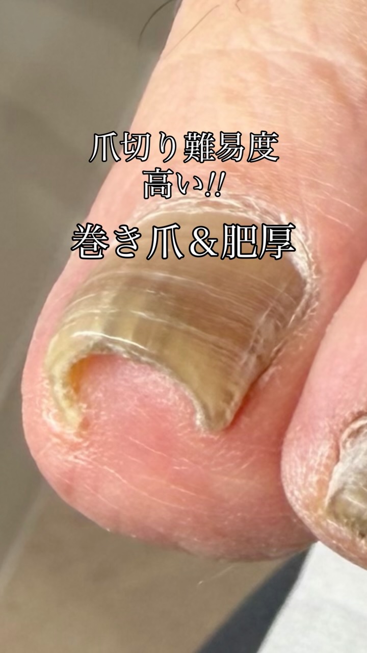 巻き爪や肥厚爪の方は
爪切り難易度高いですよね
爪切りが上手く入らず
皮膚を傷つけてしまったり
切りたい形に切れなかったり
切り残しがトゲになったり…
そんな時は私たちプロの出番!!
伸びても引っかからないように
角をとったり、厚みを整えたり◎
快適に過ごしていただくために
全力で施術いたします。
────────────
habitsフットケアスタジオ
🏠横浜市青葉区青葉台1-24-1-103
📞080-3092-4207
営業時間 9:00~18:00
定休日 日曜・水曜
────────────