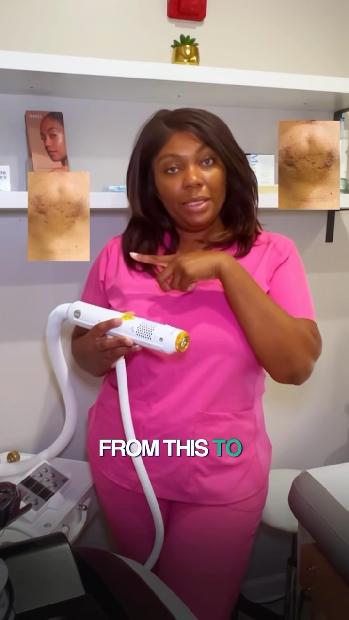 🚨 ONLY 10 MORE DAYS! 🚨
The countdown is ON! ⏰✨ You have just 10 DAYS LEFT to take advantage of our $375 LASER SALE at Pretty Faces Atlanta! 💕 🔥
This is one of our BIGGEST laser savings, and appointments are filling up FAST! Don’t wait until the last minute to get on the schedule. Results may vary from patient to patient✨
