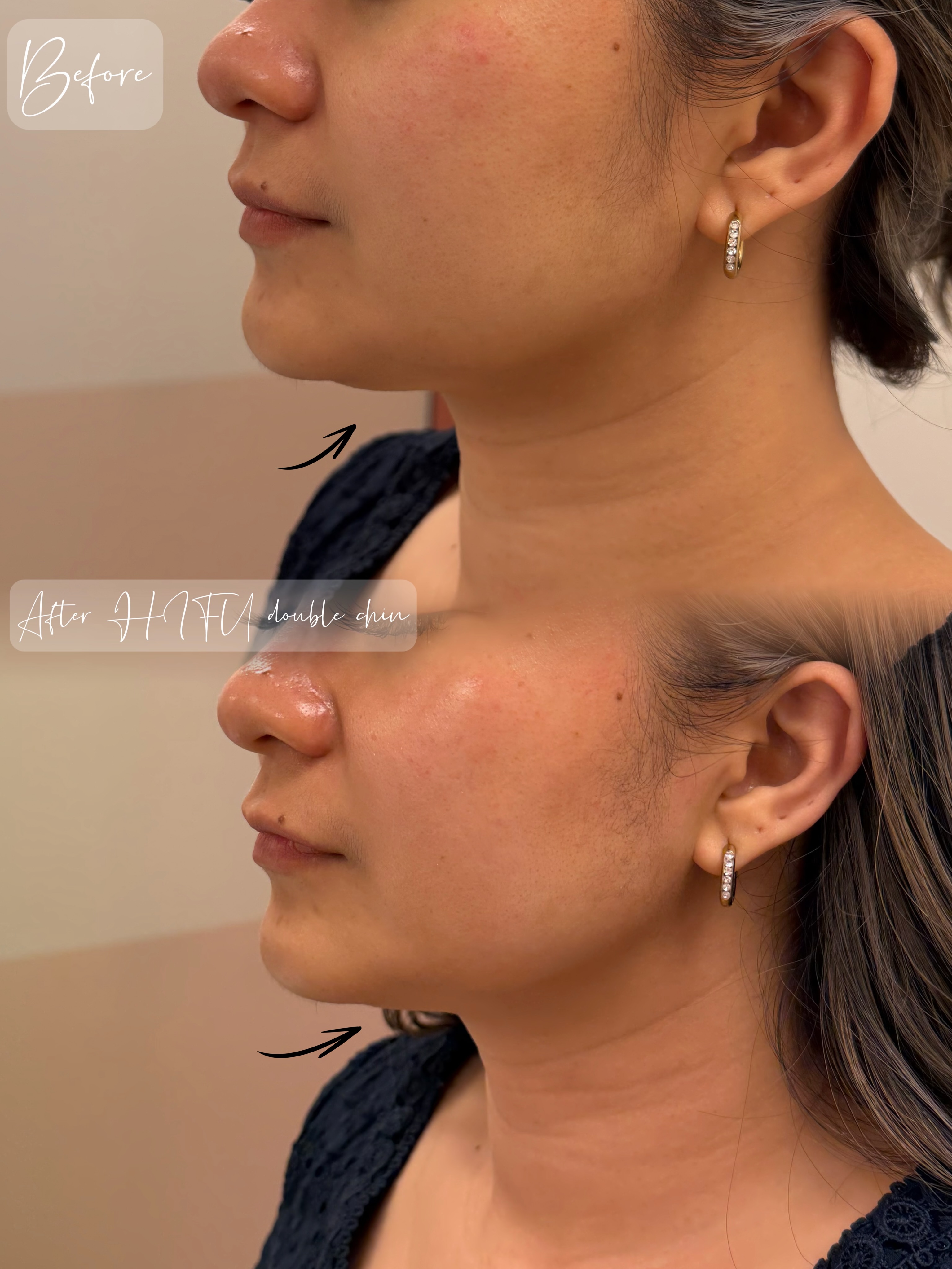 💁♀️Get rid of double chin right after #nanozellehifutreatment #skintightening #facelift #hifufacelifting #wellington