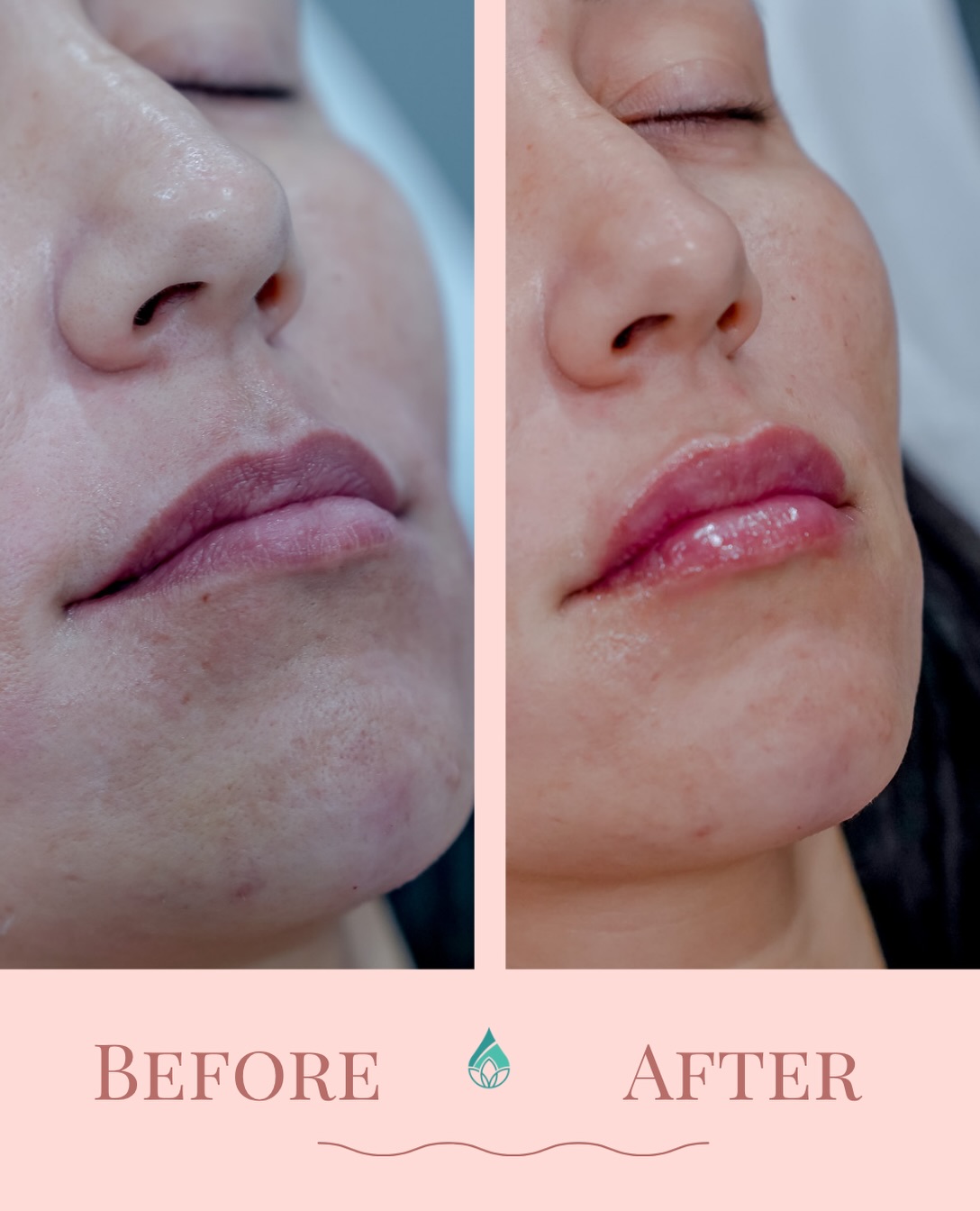 Lip filler isn’t just about your lips. 💋 It’s about how your lips fit your FACE.
It’s easy to look in the mirror and think, “I just want my lips a little fuller.”
But a thoughtful injector is looking beyond lip size.
We’re looking at how your lips relate to your:
✨ Chin
✨ Profile
✨ Cheeks
✨ Facial proportions
✨ Natural movement
👩⚕️ Sometimes the goal is more definition. Sometimes it’s restoring subtle volume. Sometimes it’s improving shape or projection. And sometimes the conversation about your lips leads us to another feature that’s influencing the balance you’re actually trying to achieve.
The goal is lips that make sense for YOUR face. 💋
Because the best filler doesn’t compete with your features—it complements them.
Ready to talk lips + facial balancing? Comment LIPS below for details 💉
#hawaiimedspa #hawaiilipfiller #hawaiiaesthetics