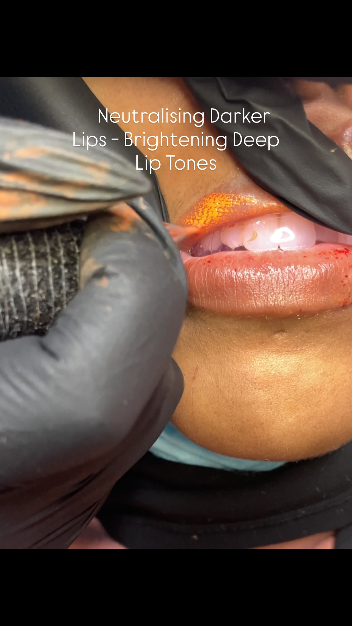 Oranges and peaches are a girls best friend๐๐
Achieve pinker, brighter lips with this treatment ๐ฉท
Multiple sessions required. Results can last 1-3 years +
Dark lip neutralisation ยฃ250 - book online at iabrows.com or DM me for the direct booking link ๐งก