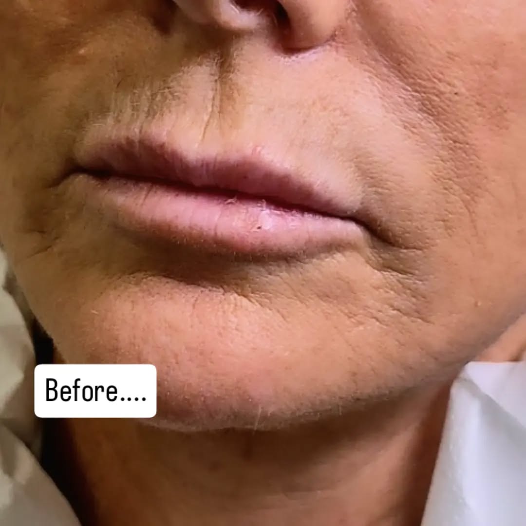 From lined and lacking definition to beautifully smooth, soft and rejuvenated lips 👄✨💉💉💉
Using my advanced lip technique, I’ve carefully restored shape and definition while softening the appearance of those fine vertical lip lines — without making the lips look overfilled.
The result? Fresher, smoother, beautifully defined lips that still look completely natural. 💋
Advanced techniques • Natural results • Tailored to you #lips #dermalfiller #advancedaesthetics #broadstairs #kent