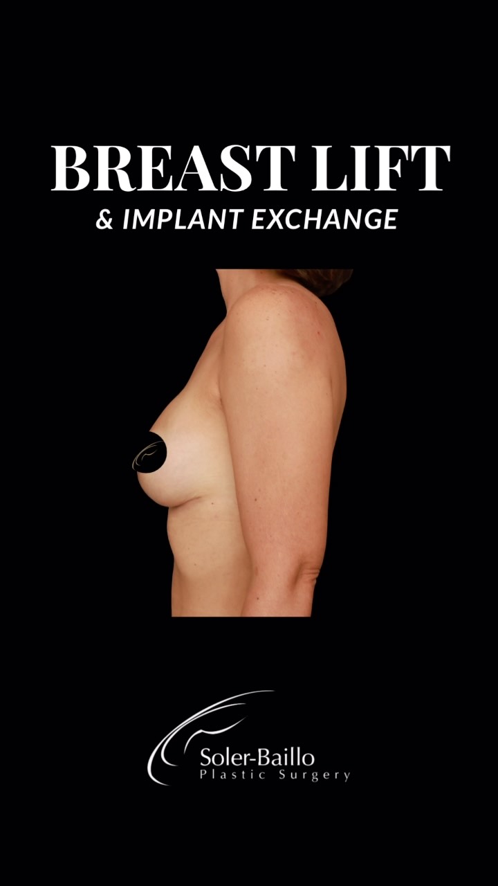 ✨ SMALLER. LIFTED. REFINED. ✨
This transformation was all about creating a lighter, more youthful silhouette while preserving beautiful proportions. 🤍
With a breast lift + implant exchange, Dr. Soler-Baillo performed a capsulorrhaphy to tighten the implant pocket, allowing her to downsize from 400cc to 265cc while maintaining a beautiful shape and position.
And one of the most overlooked details of a breast lift? The areolas can be customized too. Patients can have a say in their preferred areola size as part of creating a result that feels uniquely theirs. ✨
Because breast surgery shouldn’t be one-size-fits-all. Every detail can be thoughtfully tailored to you.
📍 The Shops at Merrick Park, Coral Gables
📞 305-661-1996
💌 DM us to schedule your consultation
#BreastLift #Mastopexy #BreastAugmentation #ImplantExchange #SolerBaillo