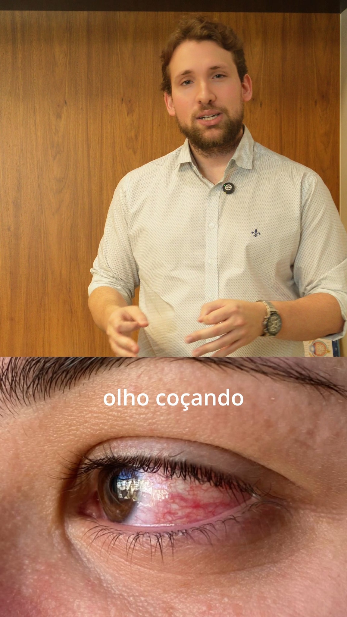 Alergia ocular não tratada e ceratocone têm uma relação direta — e poucos sabem disso.
O ato de coçar os olhos repetidamente causa microtrauma na córnea e pode acelerar a progressão da doença em quem tem predisposição.
Tem alergia ocular frequente? Agende sua avaliação pelo link na bio. 👁️💙
📍 Agende sua avaliação pelo link na bio.
Dr. Fernando Mutton
CRM SP 803999
RQE 20279
Dr. Gabriel Mutton
CRM 264060
—
#ceratocone #saúdeocular #oftalmologista #córnea #oftalmologiamutton