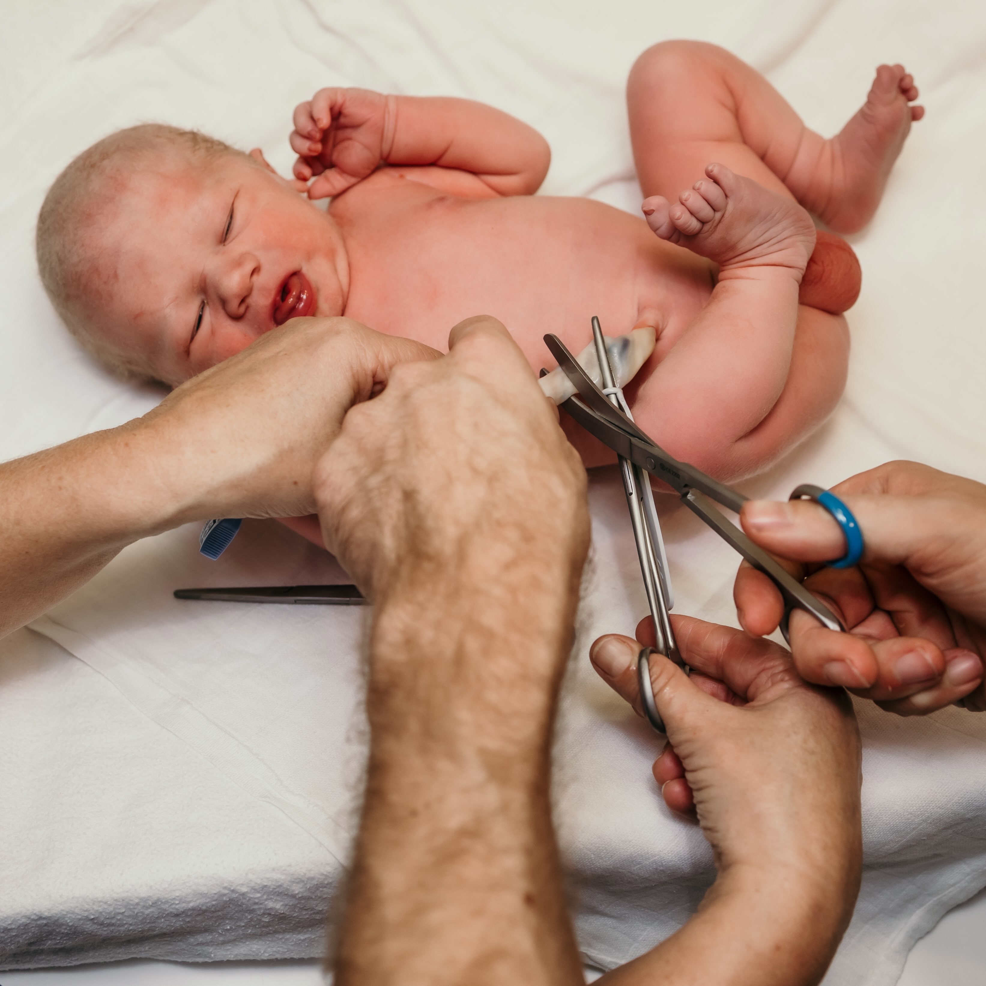 👶🏼 Navelklem of cordring?
Op deze foto, gemaakt door @noa_fotografie (met toestemming geplaatst), wordt de navelstreng doorgeknipt en staat de cordring met een kocher klaar om op de navelstreng te plaatsen. Een cordring is een alternatief voor de traditionele navelklem. Swipe naar foto 2 om het verschil te zien. * Bij de cordring wordt het uitstekende flapje na het plaatsen afgeknipt. Hierdoor blijft alleen het kleine, ronde gedeelte op de navelstreng zitten.
Een cordring moet je tijdens de bevalling zelf meenemen naar het ziekenhuis. Deze zit meestal in het kraampakket. Heb je er geen? Dan kunnen we tijdens een afspraak bij ons ook een cordring aan je meegeven.
Maar wat is nu het verschil? Beide zijn veilig en hebben hetzelfde doel: het afklemmen van de navelstreng. Een cordring is kleiner, zachter en flexibeler dan een navelklem. Hierdoor blijft hij minder snel achter kleding of de luier haken. Ook is het kleine formaat praktisch bij het aankleden en kan de navel makkelijk schoon en droog worden gehouden. Een navelklem is wat groter en steviger en wordt standaard gebruikt in het ziekenhuis.
#naveklem #cordring #verloskundigenpraktijk