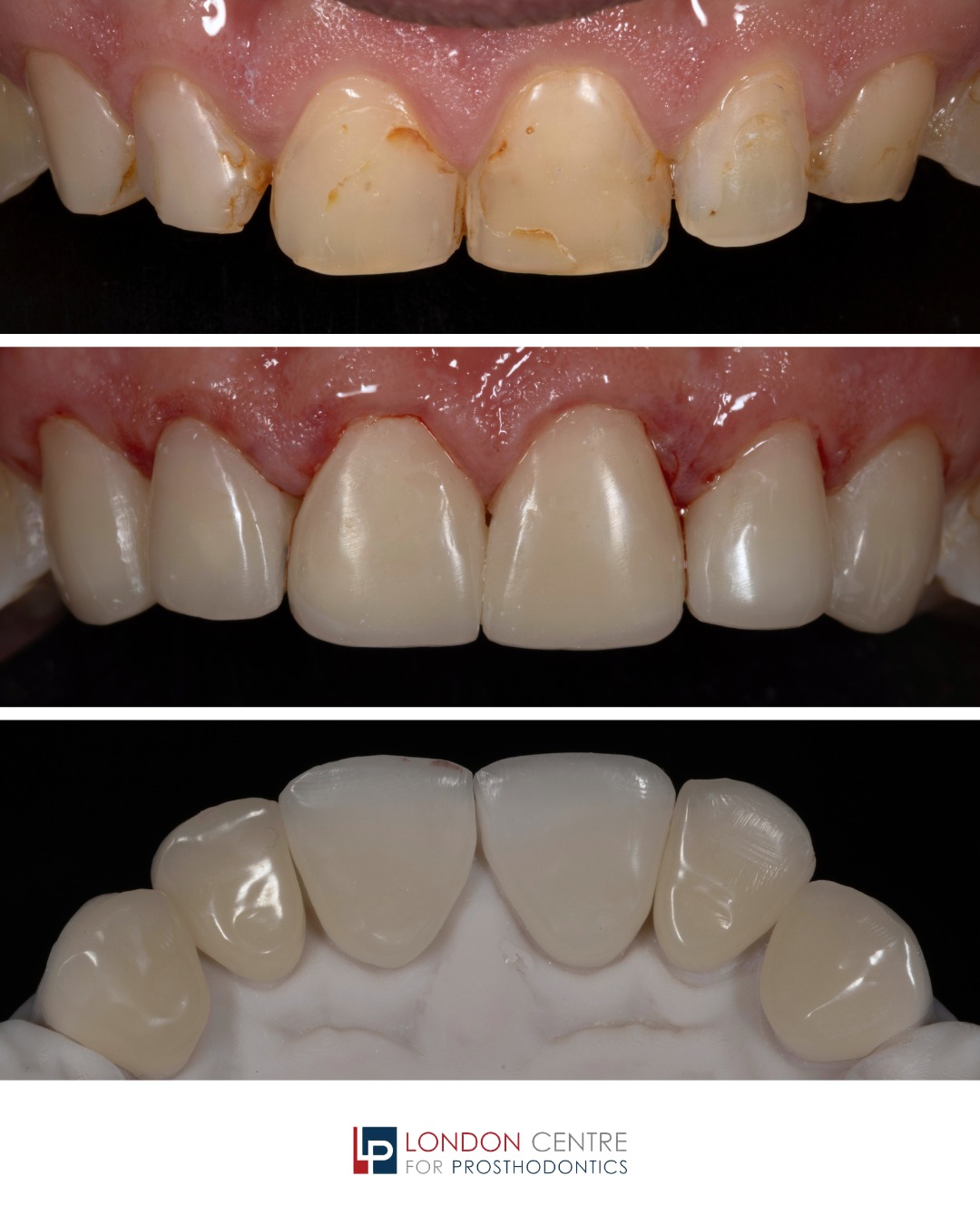Composite bonding is not always as simple as it looks.
This patient presented with severely worn upper front teeth, stained old composite bonding, and chipped edges. Aside from the visibly poor appearance, his main issue was the wear of his teeth and a deep bite.
Composite bonding alone would have not provided this patient with a stable outcome.
Our vast experience in advanced prosthodontic principles, including assessment and stabilisation of bite, allowed us to manage this in this case in an entirely conservative and predictable way.
With a controlled opening of his bite, we built up the worn teeth with laboratory-made backings that were cemented onto the worn palate surface of the upper front teeth.
Direct handcrafted composite veneers were then used to build up the front surfaces of the upper front teeth, with the support and strength provided by the palate restorations.
This case was completed entirely additively, with no cutting down or preparation of the teeth, using a painless approach.
In this way, we provided this wonderful patient with a beautiful, natural, and entirely conservative smile that will remain stable and predictable in the long term.
Before you embark on a course of composite bonding, are you entirely sure that your bite is favourable and the risk of chipping has been controlled?
Our aim is to guide you through the treatment process, inform you of the risks, and provide you with a beautiful and stable long-term outcome.
Get in touch with our team to book your appointment - we look forward to seeing you soon!
The London Centre For Prosthodontics
29 Weymouth Street
London, W1G 7DB
020 7637 4518
info@londonprosthodontics.com
Monday - Friday: 7:15am - 4:30pm
#SmileMakeover #EmergencyDentistLondon #LondonDentalClinic #SmileTransformation #CosmeticDentistLondon
