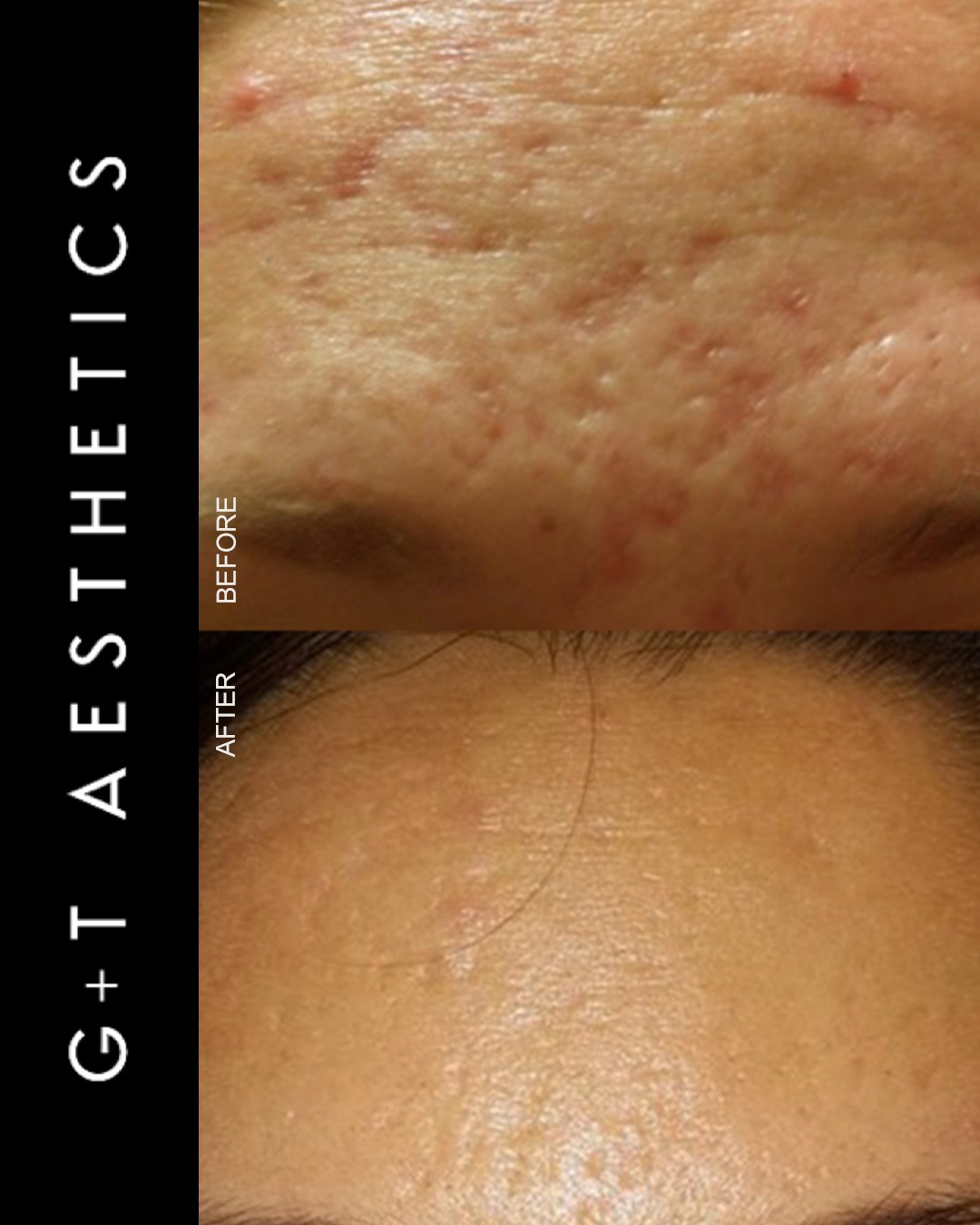 Collagen stimulation. Skin renewal. Visible improvement. ✨
SkinPen microneedling works by creating controlled micro-injuries in the skin to stimulate its natural healing response and support new collagen production.
📲Enquire or visit www.gtaesthetics.co.uk for more info.
#SkinPen #Microneedling #BeforeAndAfter #CollagenBoost #SkinRejuvenation