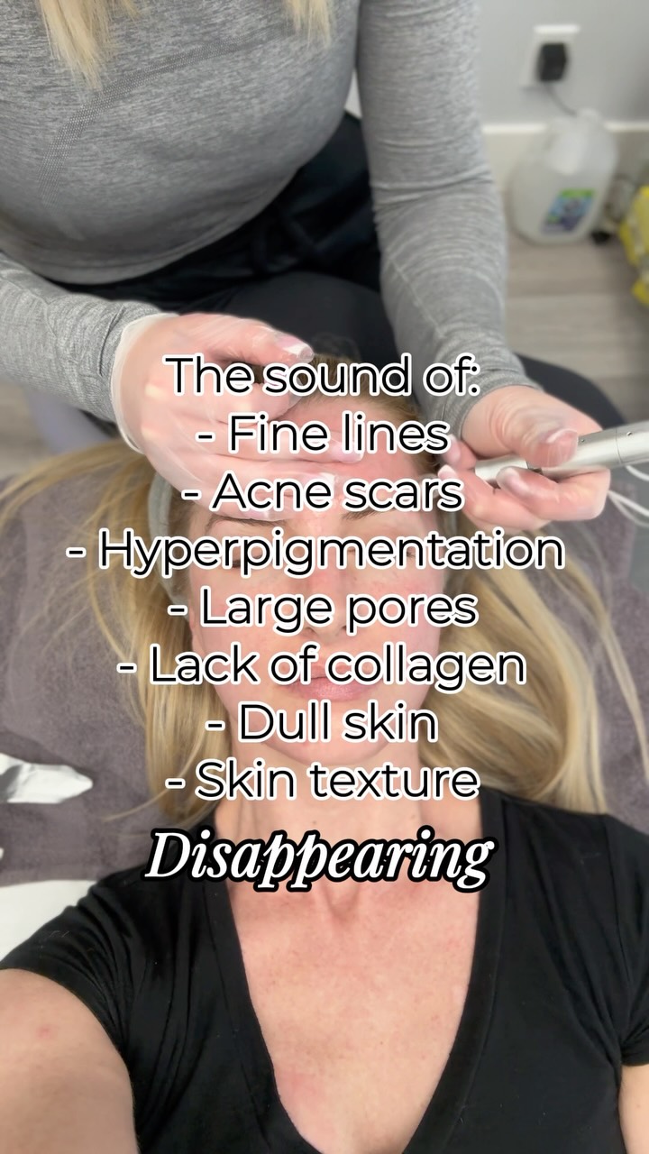 BUY 3, GET ONE FREE! Microneedling is already a powerhouse for stimulating collagen and improving the look of texture, pores, fine lines and uneven tone. Pair it with PRX, and we’re taking the treatment up a notch.
PRX works beneath the surface to help stimulate skin renewal and improve brightness, firmness and overall skin quality—without the heavy peeling you might expect from a traditional peel. Combined with the controlled micro-injuries of microneedling, it’s one of our favorite combos for skin that needs a serious refresh.
From now through the end of September, microneedling treatments are Buy 3, Get One FREE. You can also save $50 off a PRX treatment 💜
📍 Tighter Lines Aesthetics | Jupiter, FL
Ask us if PRX + microneedling belongs in your treatment plan. (561) 203-2765
#jupiterfl #tighterlines