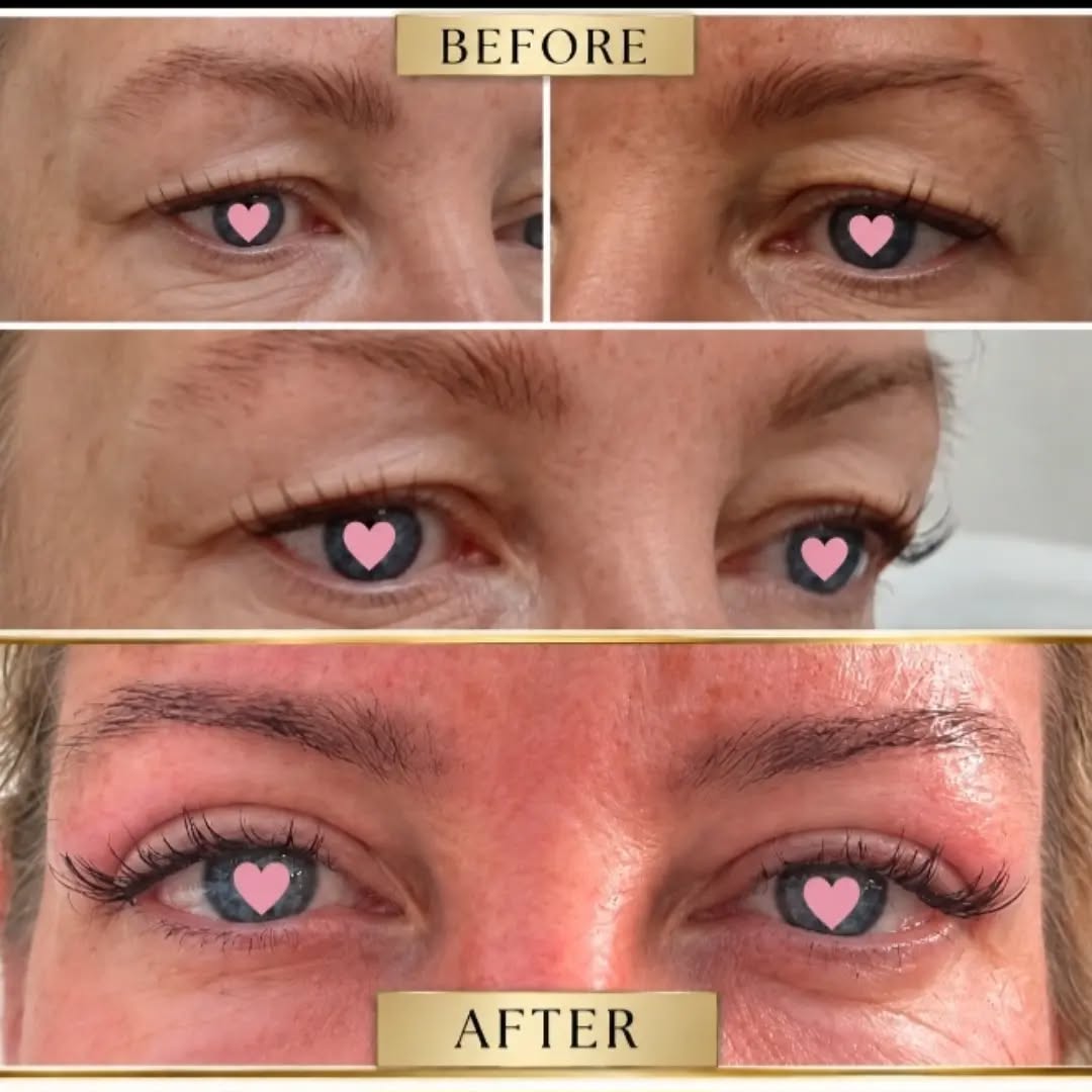 ✨ ONE SESSION. ONE INCREDIBLE TRANSFORMATION. ✨
IF YOU HAVE HOODED EYE LIDS 👀, LOOSE SKIN UNDEREYES OR DEEP LINES ABOVE YOUR LIPS👄...SEE ME!
I have literally transformed this lady’s eyelids in just ONE session of my Signature Plasma Fibroblast treatment.
I don’t use the traditional dotting technique. I’ve developed my own signature technique, built on years of experience and designed to achieve results like these.
This is what expertise, experience and technique can achieve. #eyelidlift #transformeyelids #smokerslines
#undereyebags #kent