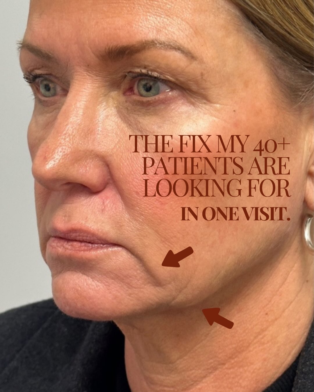 Aging follows a pattern🧬 The science is predictable — the art is knowing exactly where and how to treat it.
Most patients want one thing: visible improvement, zero downtime, no one able to tell “what you did.” They just don’t know what’s actually possible for their face.
Luckily, I do. Same-day results. No downtime. And a result that looks like this.
Consult links are in my bio — spots for this month are filling up.