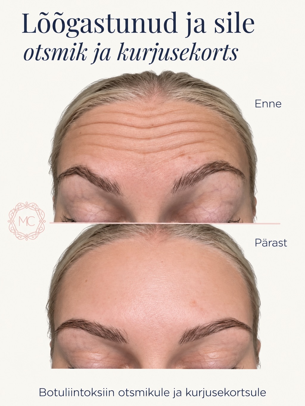 ✨ Lõõgastunud ja sile otsmik ning kurjusekorts
Botuliintoksiinravi eesmärk ei pea olema miimika täielik kaotamine. Hästi planeeritud protseduur aitab lõõgastada ülemäära aktiivseid miimilisi lihaseid ning pehmendada nende tööst tekkinud kortse, säilitades samal ajal loomuliku ilme.
Pildil on tulemus pärast botuliintoksiini süste otsmikule ja kulmudevahelisse piirkonda 🤍
Tulemuseks on
- siledam ja puhanum otsmik
- pehmenenud kurjusekorts
- avatum ja värskem ilme
- loomulik tulemus ilma näojooni muutmata
Sobiv süstepiirkond ja ravimi kogus valitakse alati individuaalselt vastavalt näo anatoomiale, lihaste aktiivsusele ja soovitud tulemusele.
Loomulik tulemus tähendab tasakaalu — mitte liikumatut nägu 🤍
#ilukliiniktartus #botuliintoksiinisüstid #otsmikukortsud #kurjusekortsustvabaks #tartu