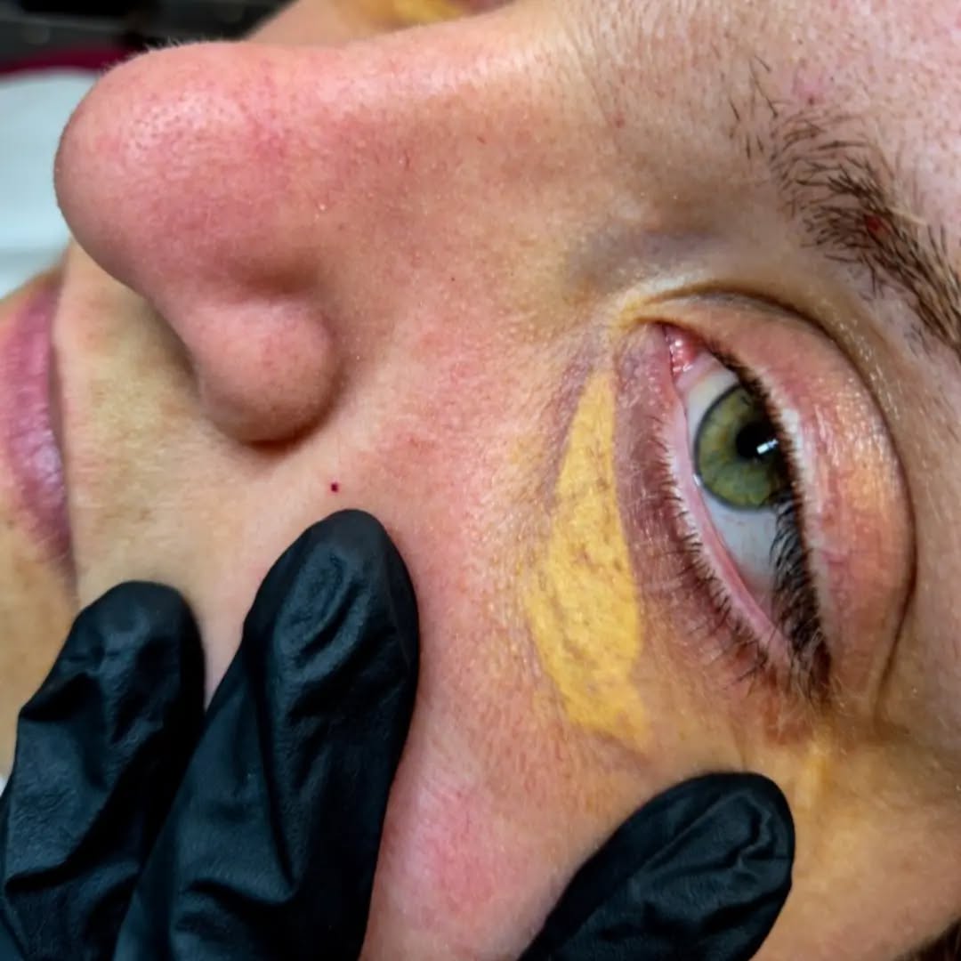 ✨ XANTHELASMA – MORE THAN JUST A COSMETIC CONCERN!!✨
My lovely client came to me feeling completely at a loss. The yellow deposits under her eyes had become so noticeable that she’d lost her confidence, avoided going out and felt as though people were staring at her.
Having worked in aesthetics for 13 years, I recognised the signs of xanthelasma straight away and advised her to see her GP and have her cholesterol checked. Xanthelasma can be associated with high cholesterol and other cardiovascular risk factors — and in her case, her tests did reveal high cholesterol.
But that still left the visible deposits that were making her so unhappy.
Using my plasma technique, I treated the xanthelasma while also working on the loose under-eye skin and dark circles. This required a more intensive approach than my usual plasma treatment, drawing on my expertise.
The result has been incredible. ❤️
The yellow deposits are gone, the under-eye area is tighter and rejuvenated, and most importantly, she told me she has her confidence back.
That’s why I love what I do. ✨
Xanthelasma should always be medically assessed, as cosmetic treatment does not address any underlying cholesterol or cardiovascular risk.
#xanthelasmaremoval #cholesteroldeposit #plasmaexpert #advancedaesthetics #kent