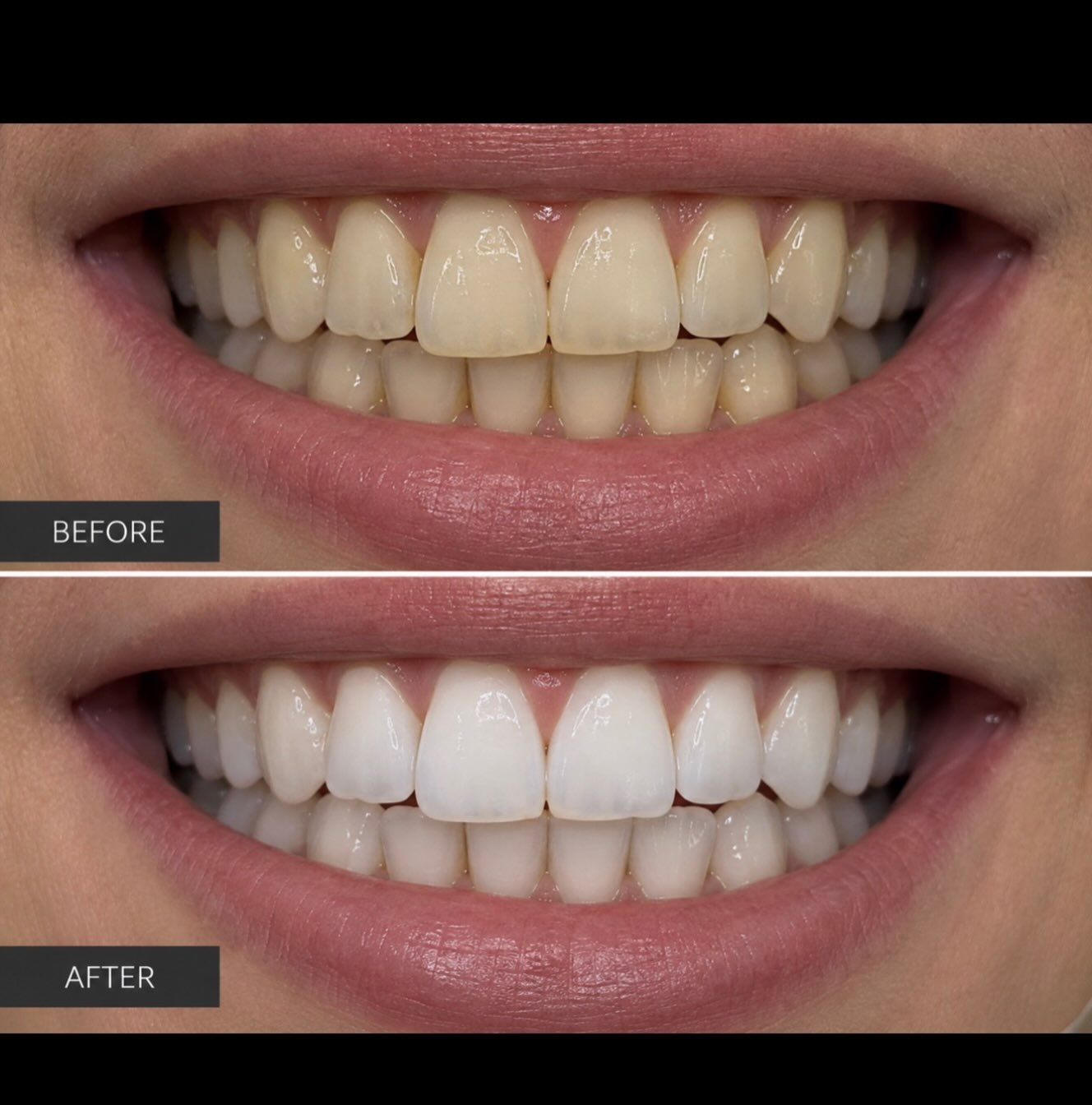 When your smile is already beautiful… but a little whitening makes it unforgettable. ✨
At Happy Smiles Dental, we offer two premium teeth whitening options:
✨ Enlighten Whitening
✨ Boutique Whitening
Book your free consultation and let us help you choose the option that’s right for you😍🦷🤍
#teethwhitening #beautifulsmiles #smilemakeover #dentistlondon #dental