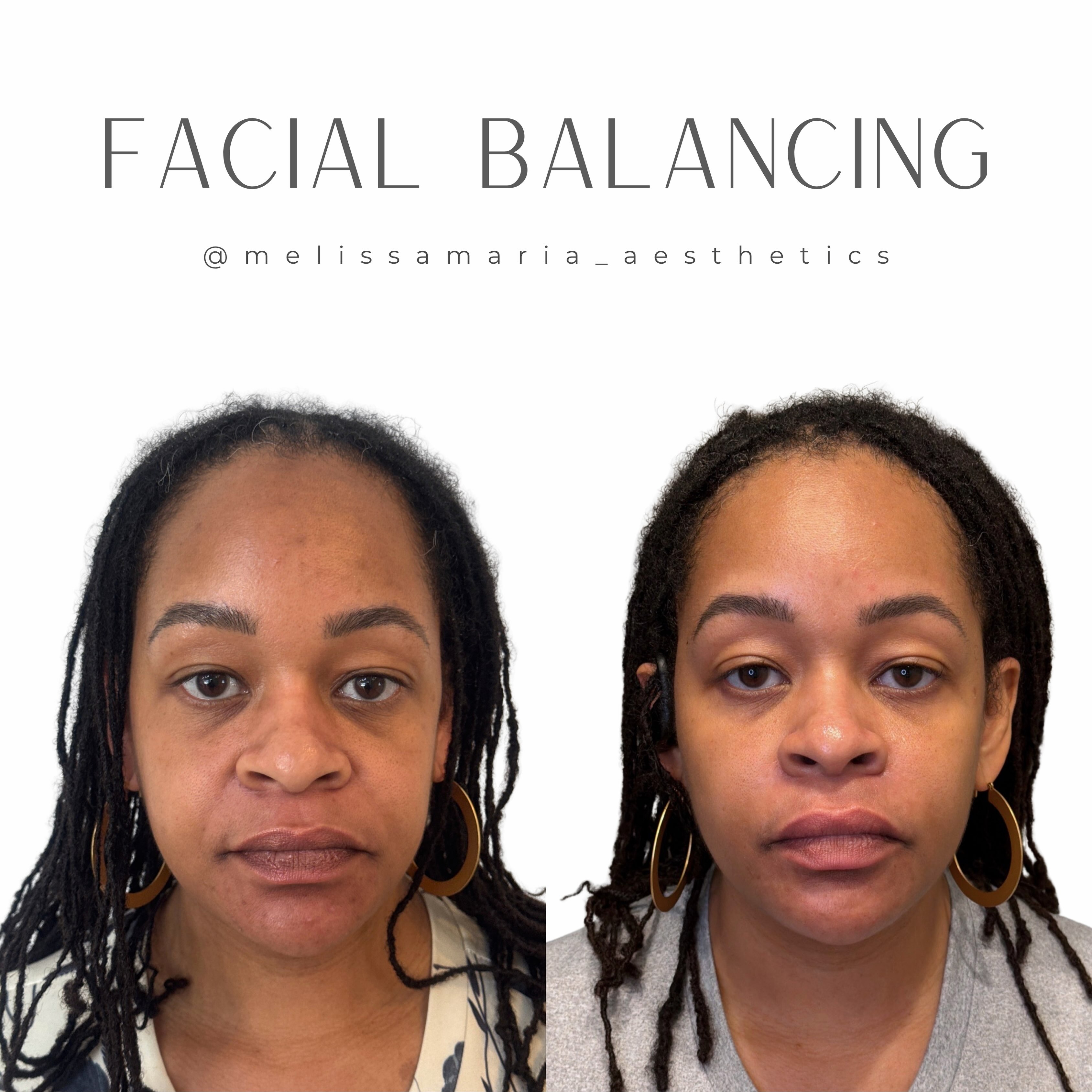 Can we just appreciate this improvement.
Just upon initial assessment. There was a significant change in her volume distribution. All of the volume in her face had slid to the lower half of her face.
With her facial balancing the goal was to redistribute the volume to the upper half of her face. And reduce the negative vector’s and shadowing in the following areas.
1. Under eye exaggeration of her tear troughs.
2. Loss of volume in her cheek
3. Soften her nasolabial fold.
4. Lip filler to balance her lower face.
5. Chin shadowing.
The best part about this before and after.
Her after in this photo was 3 months after her treatment and only after 1 treatment of biostimulation in her Nasolabial folds.
#facialbalancingnc #facialbalancingraleigh #facialbalancinggreensboro #facialbalancingcharlotte