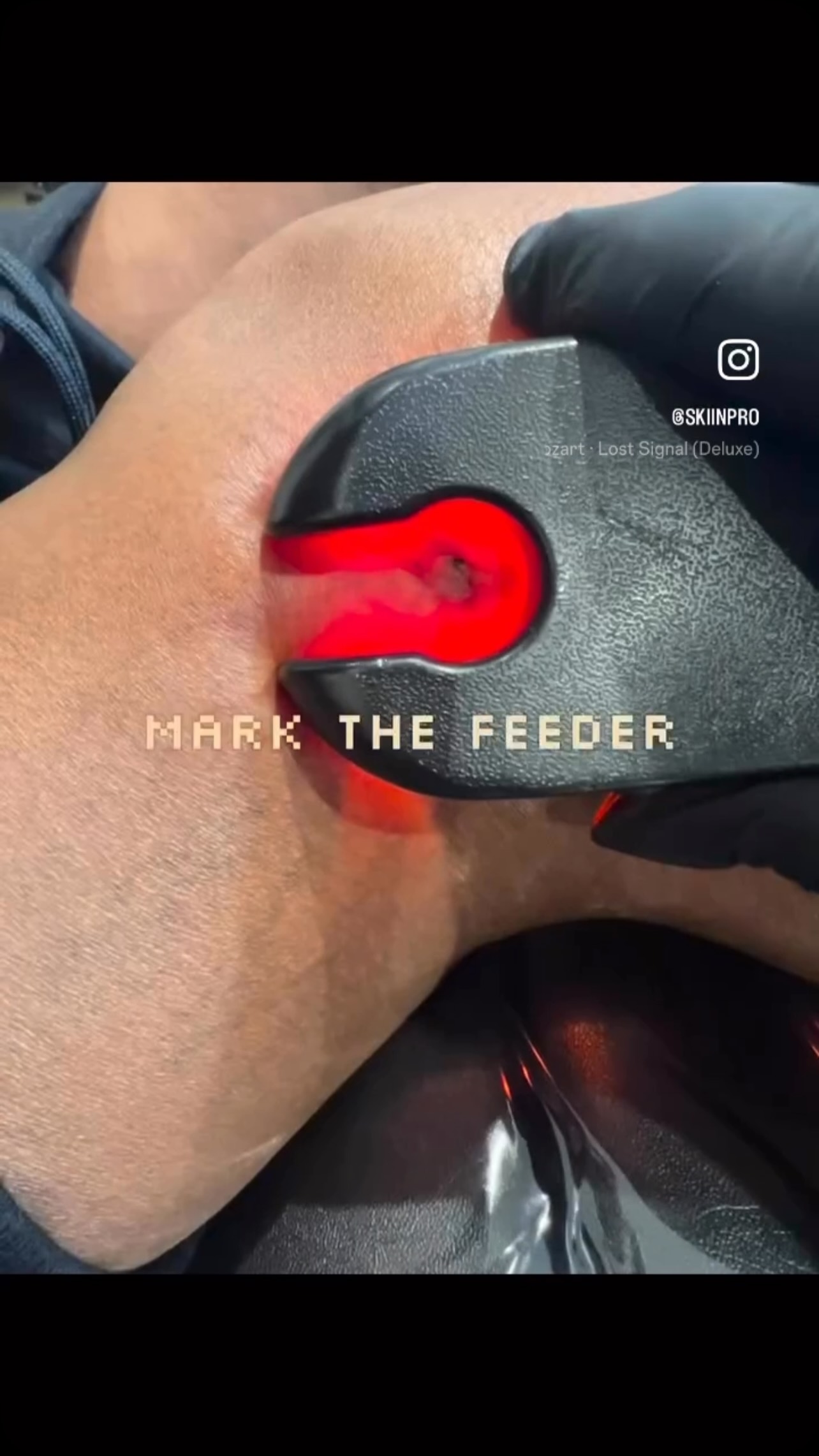 Think treating thread veins is simply a case of injecting the vein? Think again. 👀
Successful microsclerotherapy starts before the needle ever touches the skin.
If you’re treating spider and thread veins — or considering adding microsclerotherapy to your aesthetic practice — you need to understand what you’re actually treating, why the vein is there, and when NOT to inject.
Our Microsclerotherapy Training is designed for UK practitioners who want to develop genuine clinical understanding, not simply learn a set of injection techniques.
On the course, we cover:
✔️ Lower-limb venous anatomy & practical vein mapping
✔️ Understanding reflux and why it matters
✔️ Sclerosant selection, concentrations & safe volumes
✔️ Treatment planning and when to re-treat
✔️ Managing trapped blood and common post-treatment issues
✔️ Veins to avoid & important safety red flags
✔️ Consultation, consent & clinical documentation
✔️ Complication recognition and management
✔️ Hands-on clinical training with real patient assessment
Because confident treatment comes from knowing what to treat, what not to treat, and why.
Small groups. In-depth clinical training.
Practical experience. Ongoing support.
If you’re ready to add microsclerotherapy to your skill set — or take your existing treatments to a more confident clinical level — DM “VEINS” for course dates and availability.
📍 UK-based training
🎓 Professional aesthetic training
👩⚕️ Designed for practising aesthetic/medical practitioners
#MicrosclerotherapyTraining
#SclerotherapyTraining
#MicrosclerotherapyUK
#AestheticTrainingUK
#aestheticpractitioner