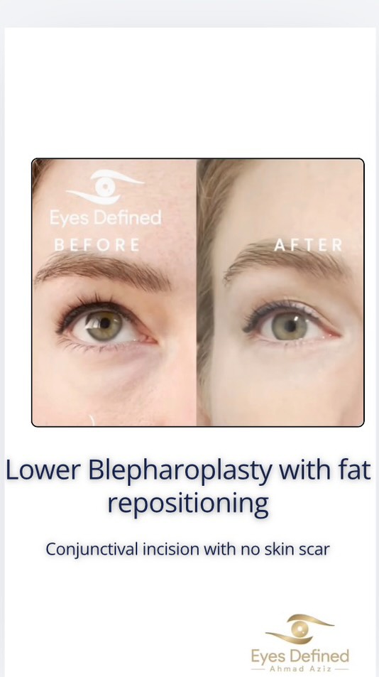 ✨ Final results are in! ✨
This lovely patient underwent bilateral lower eyelid transconjunctival blepharoplasty with fat repositioning — all done without any external skin scar.
We previously shared her 2-week post-op progress, and now you can see the beautifully natural outcome. No more eye bags, no visible scars, and a refreshed look that still looks like her.
This technique allows for precise sculpting of the lower eyelids while preserving the integrity of the skin — ideal for patients wanting a subtle, scarless rejuvenation.
📍Performed in London by a specialist oculoplastic surgeon.
#BlepharoplastyLondon #EyelidSurgeryLondon #OculoplasticSurgeon #TransconjunctivalBlepharoplasty #LowerEyelidSurgery #NoScarBlepharoplasty #FatRepositioning #NaturalResults #EyeBagRemoval #LondonAesthetics #EyelidRejuvenation #Oculoplastics #FacialAestheticsLondon #BlepharoplastyBeforeAndAfter #EyelidExpert #LondonSurgeon #YouthfulEyes #RefreshYourLook #ScarlessSurgery