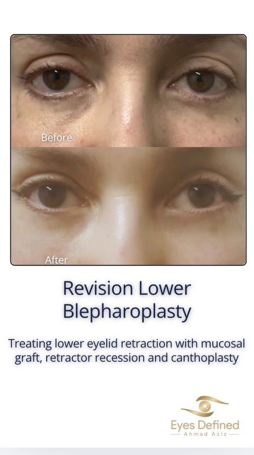 This patient developed lower eyelid retraction and difficulty closing the eyes fully following bilateral lower blepharoplasty. Revision surgery was performed using bilateral canthoplasty and mucosal grafting to help restore eyelid position, improve comfort and achieve a more natural appearance.
Revision eyelid surgery is often significantly more complex than primary surgery and requires careful assessment, realistic expectations and a strong focus on both function and appearance.
#lowerblepharoplasty #blepharoplasty #revisionblepharoplasty #oculoplastics #eyelidsurgery #lowerlidretraction #canthoplasty #eyelidspecialist #londonsurgeon #oculoplasticsurgeon #facialplastics #eyelidrevision #harleystreet #beforeandafter #eyesdefined