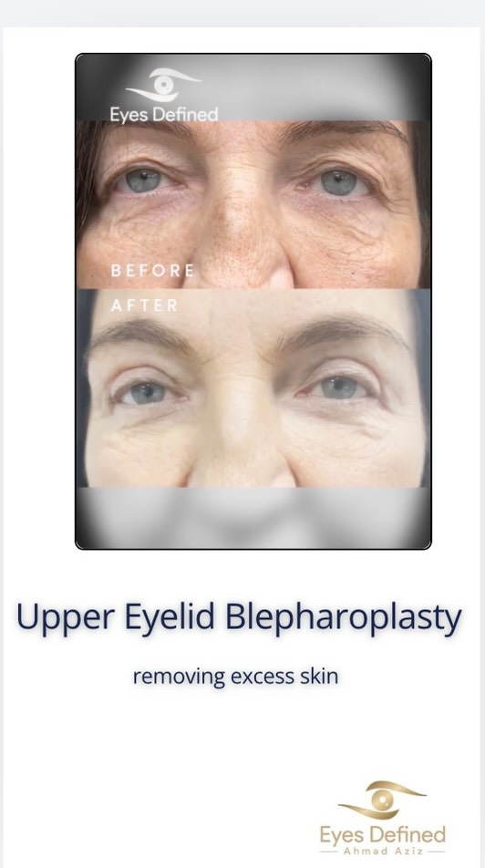 A subtle yet powerful transformation — reducing upper eyelid hooding to restore a more refreshed, open-eyed appearance.
Performed with precision and an artistic eye for natural results.
📍 London | Oculoplastic Surgeon
📩 DM to book a consultation
#UpperEyelidBlepharoplasty #BlepharoplastyLondon #EyelidSurgery #OculoplasticSurgeon #FacialAesthetics #LondonAesthetics #EyelidRejuvenation #NaturalResults #EyelidLift #BeforeAndAfter #EyeMakeover #AestheticSurgery #RefreshYourLook