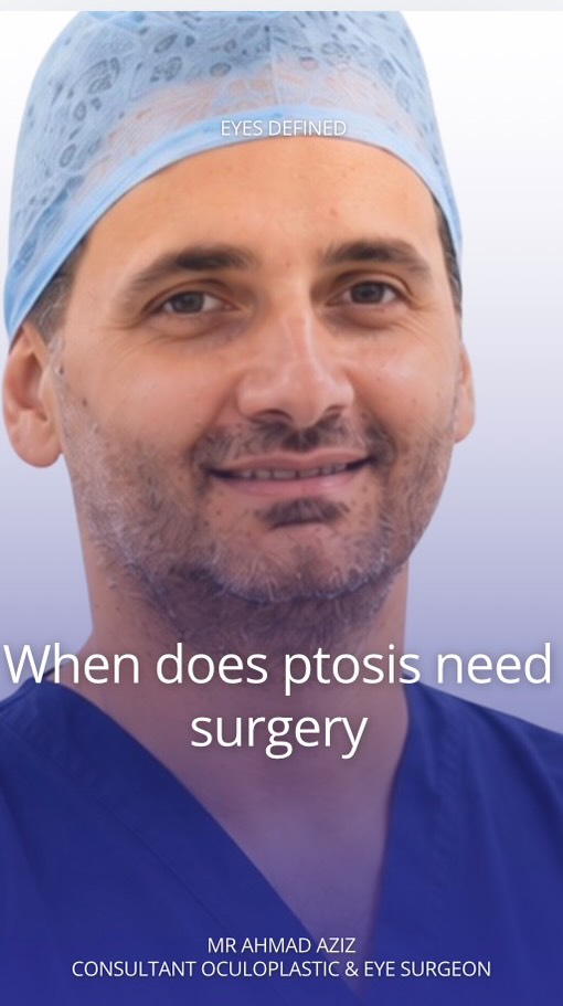 Struggling with droopy eyelids? 🧐 Ptosis surgery can restore both vision and confidence — but when is the right time to consider it? 👁️🗨️ London-based oculoplastic surgeon Ahmad Aziz explains the signs, symptoms, and best timing for ptosis correction. Watch now for expert advice!
#PtosisSurgery #OculoplasticSurgeon #EyelidSurgery #LondonSurgeon #EyeHealth #VisionCare #Blepharoplasty #MedicalAdvice #PtosisAwareness #EyeSpecialist #Oculoplastics #DroopyEyelids
