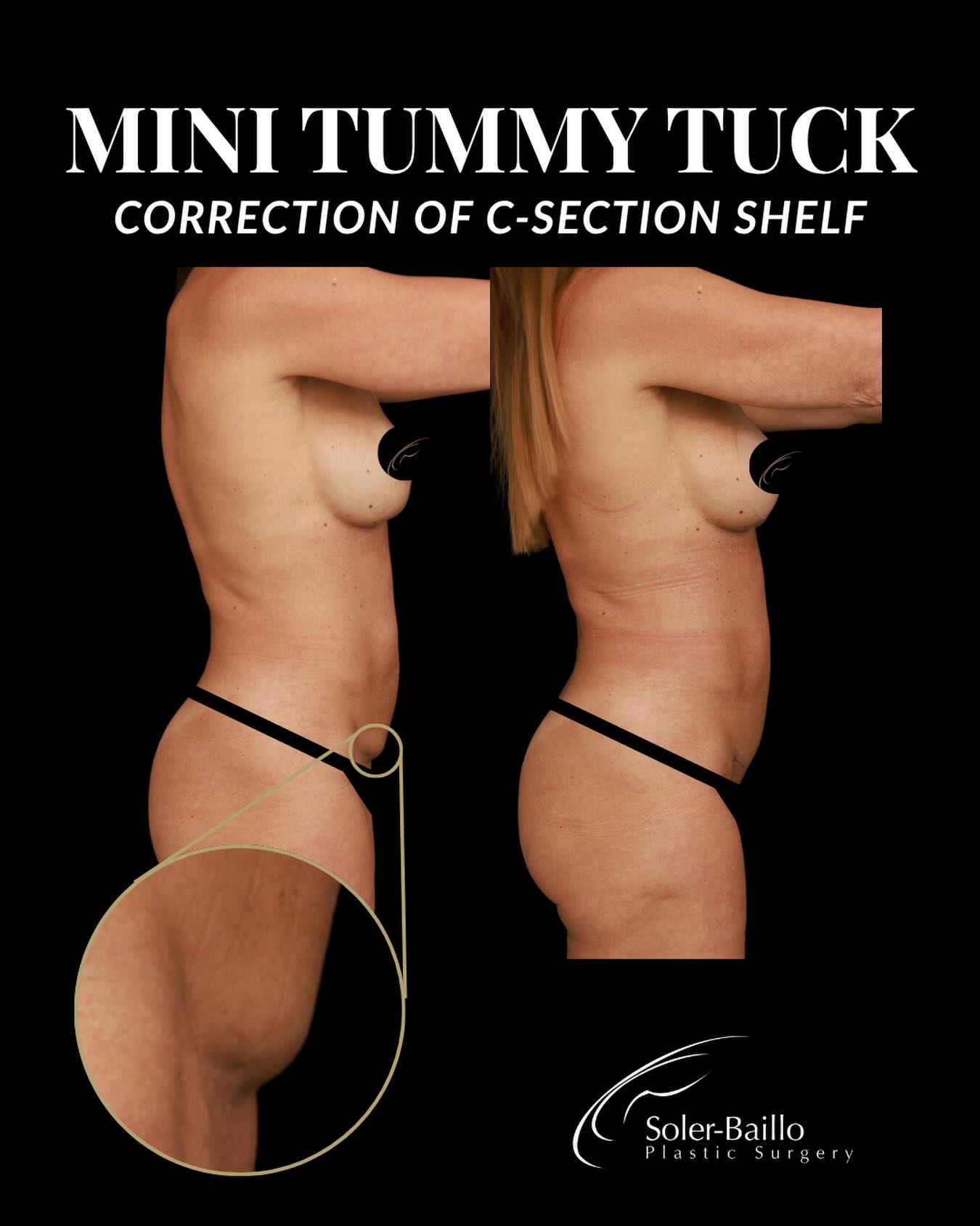 DO YOU HAVE A SHELF? 👀
That stubborn bulge above a C-section scar can be frustrating, even when the rest of your abdomen has healed beautifully.
During a C-section, the primary goal is to safely deliver your baby and close the incision. Scar placement, contour, and aesthetic refinement may not be the primary focus, which can sometimes leave women with a raised scar or a shelf-like appearance.
With a plastic surgeon’s approach to revision, the goal is to refine the scar, improve the contour, and create a smoother transition between the lower abdomen and bikini line.
Because your body deserves thoughtful care, too. ✨
📍 Shops at Merrick Park, Coral Gables
📞 305-661-1996
#CShelf #CSectionScarRevision #ScarRevision #PlasticSurgery #DrSolerBaillo
