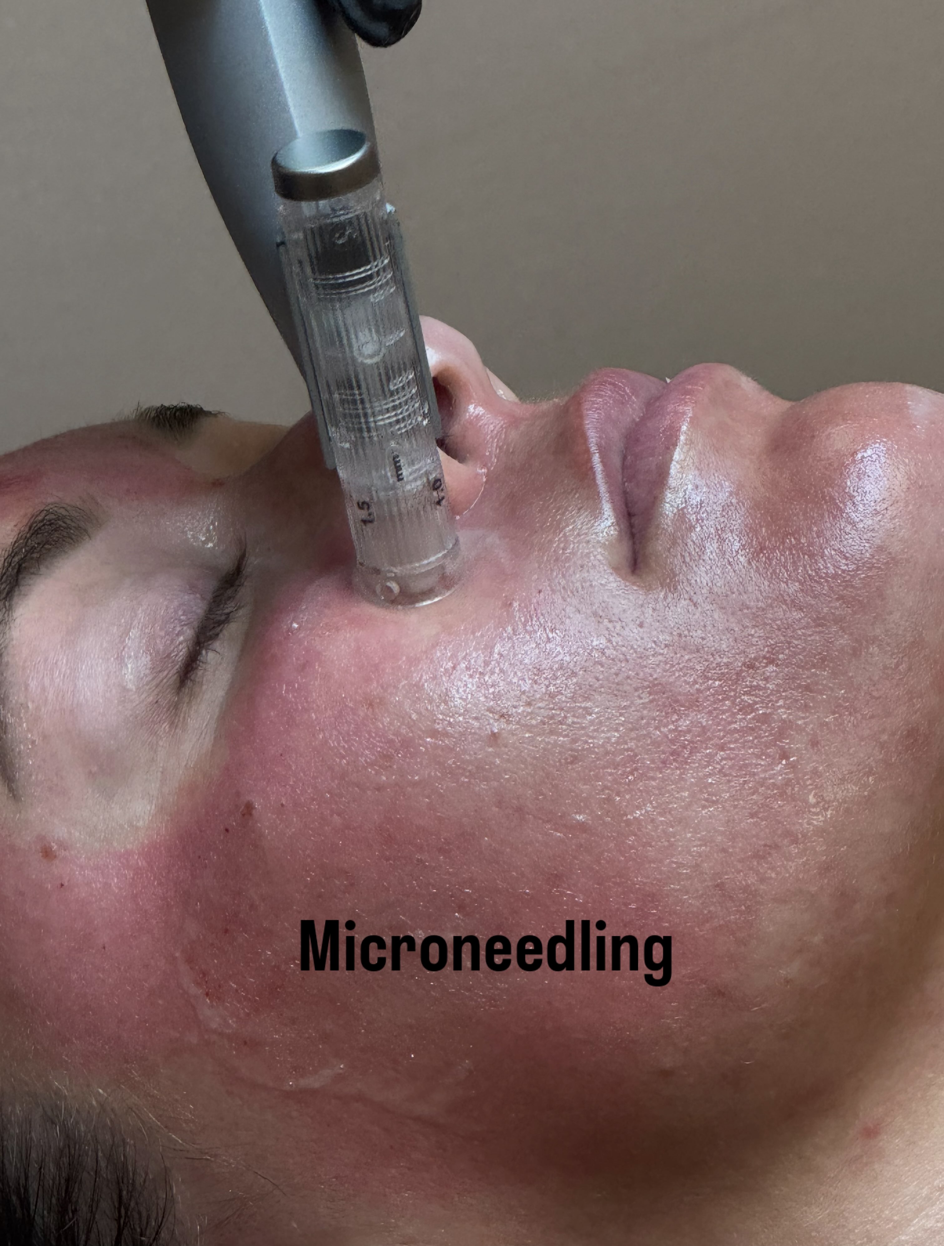 ✨ MICRONEEDLING ✨ SWIPE TO SEE THE PROCESS!🤩
One of our favorite treatments for smoother, firmer, more youthful-looking skin! 💕
Microneedling stimulates your skin’s natural production of collagen & elastin to help:
✨ Soften fine lines & wrinkles
✨ Improve skin texture & tone
✨ Minimize the appearance of pores
✨ Improve acne scars
✨ Create firmer, smoother-looking skin
✨ Boost your natural glow
Healthy skin starts with collagen. Let’s stimulate yours! 💗
📍 Herrington Aesthetics
401 Lowell Drive, Suite 24
Huntsville, AL 35801
📞 256-534-7005
#HerringtonAesthetics #Microneedling #HuntsvilleAesthetics #Collagen #SkinRejuvenation