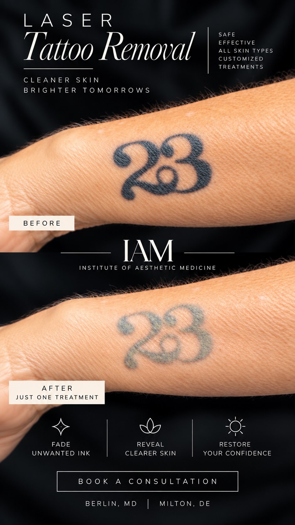 One treatment. ⨠That much fading.
Laser tattoo removal is a processābut sometimes the progress after just one session speaks for itself. This tattoo is already significantly lighter after a single treatment, with more fading to come as the body continues to clear fragmented pigment.
At IAM, we customize laser settings to the tattoo, pigment, and skin type for effective removal while prioritizing skin integrity.
Ready to fade the ink youāve outgrown? š¤
š Berlin, MD + Milton, DE
š² Consultations available
#IAM #InstituteOfAestheticMedicine #LaserTattooRemoval #TattooRemoval #TattooRemovalBeforeAndAfter PicoLaser LaserResults BeforeAndAfter BerlinMD MiltonDE DelmarvaAesthetics