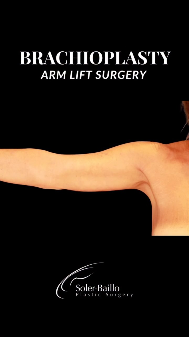 ✨ Refined arms, thoughtfully sculpted.
Brachioplasty, also known as an arm lift, removes excess skin to create a smoother, more defined arm contour.
Every detail matters, including scar placement. Dr. Soler-Baillo strategically positions the incision along the inner arm to help keep the scar as discreet as possible while achieving beautiful, natural-looking results.
Because the art of plastic surgery is in the details. 🤍
📍 Shops at Merrick Park
📞 305-661-1996
#Brachioplasty #ArmLift #PlasticSurgery #DrSolerBaillo #MiamiPlasticSurgery